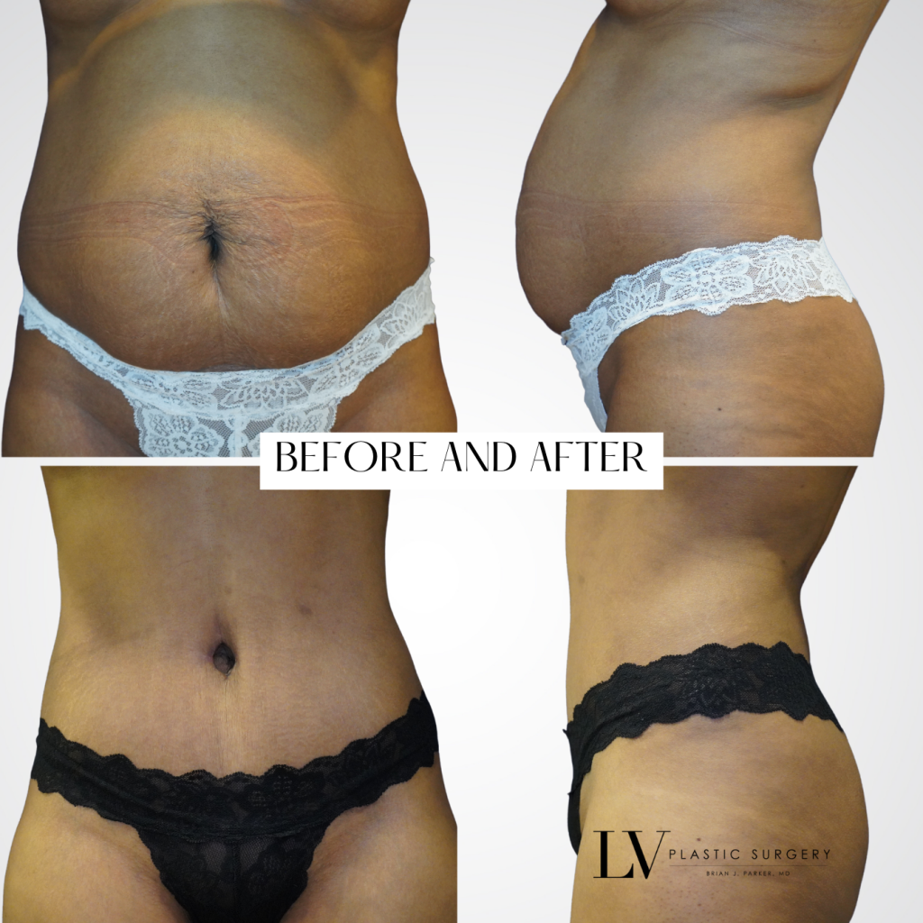 tummy tuck before and after