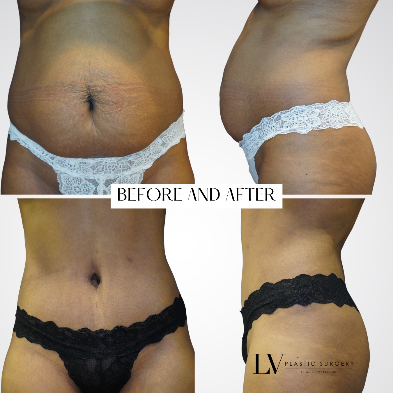 Recovering From A Tummy Tuck