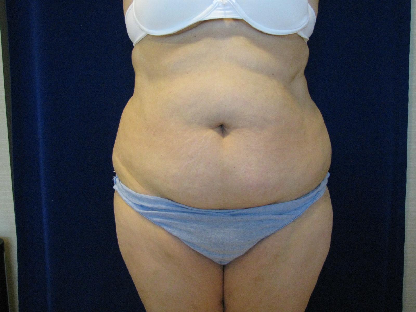 Abdominoplasty Before and After | LV Plastic Surgery