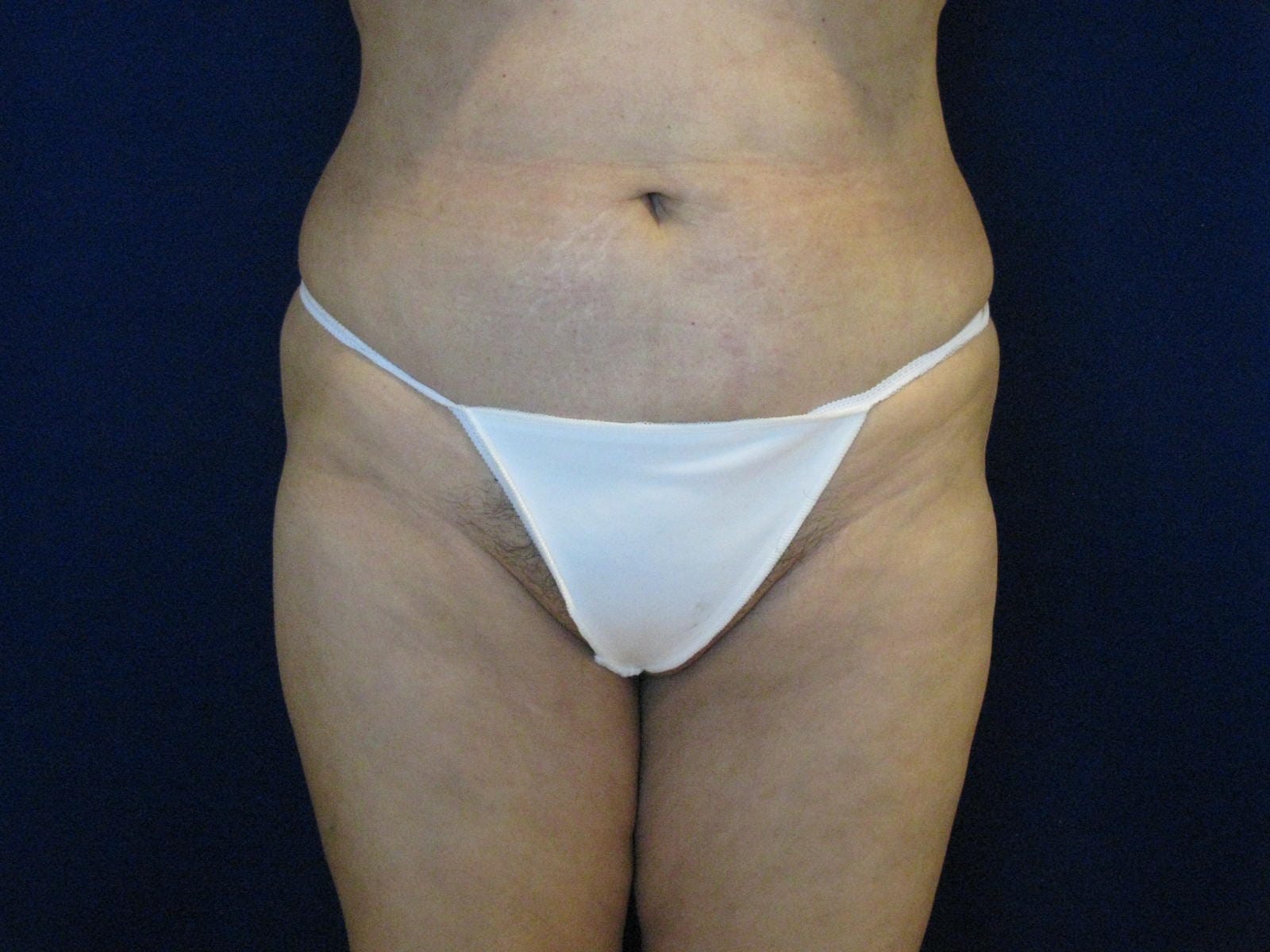 Abdominoplasty Before and After | LV Plastic Surgery