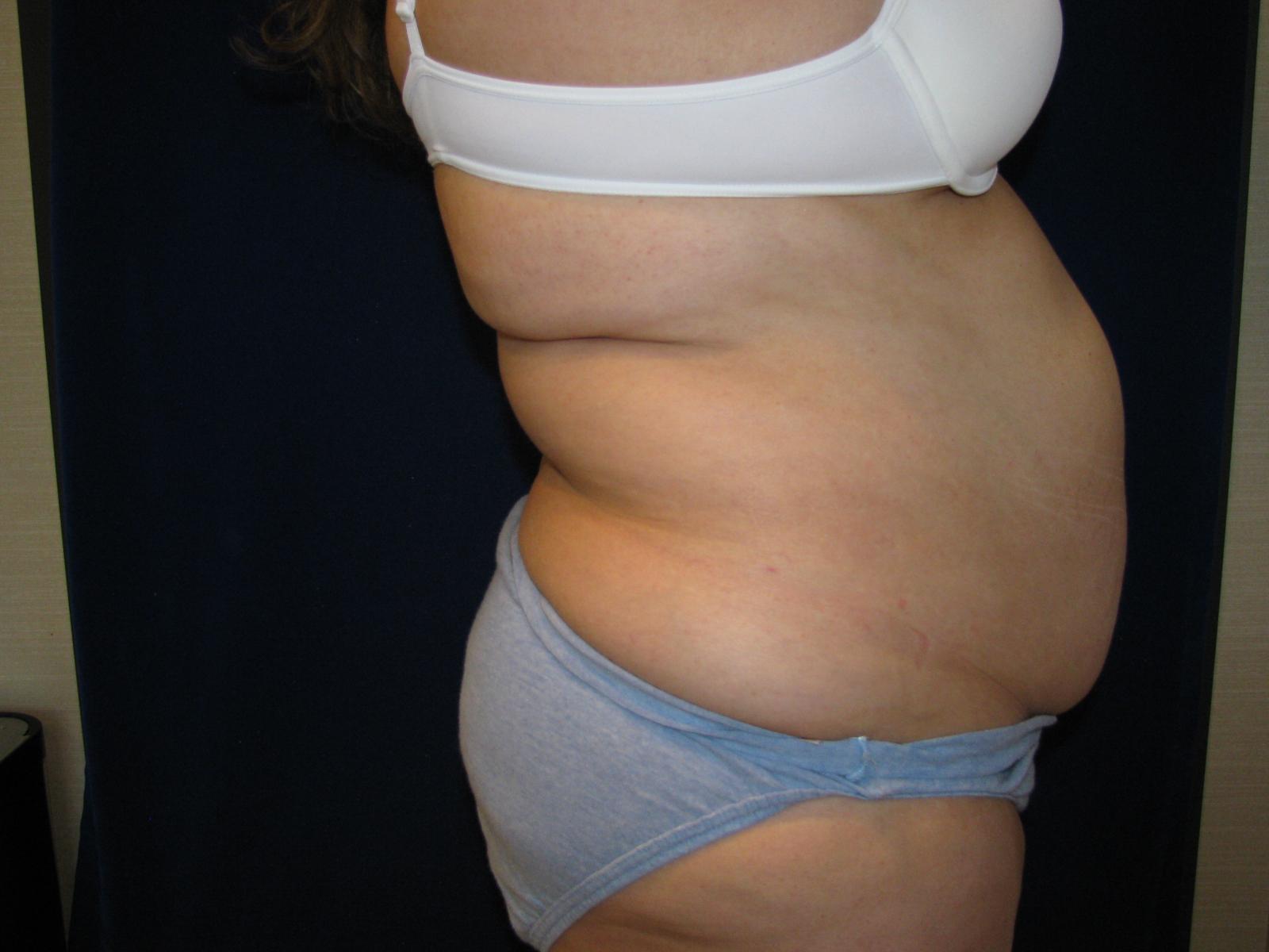 Abdominoplasty Before and After | LV Plastic Surgery