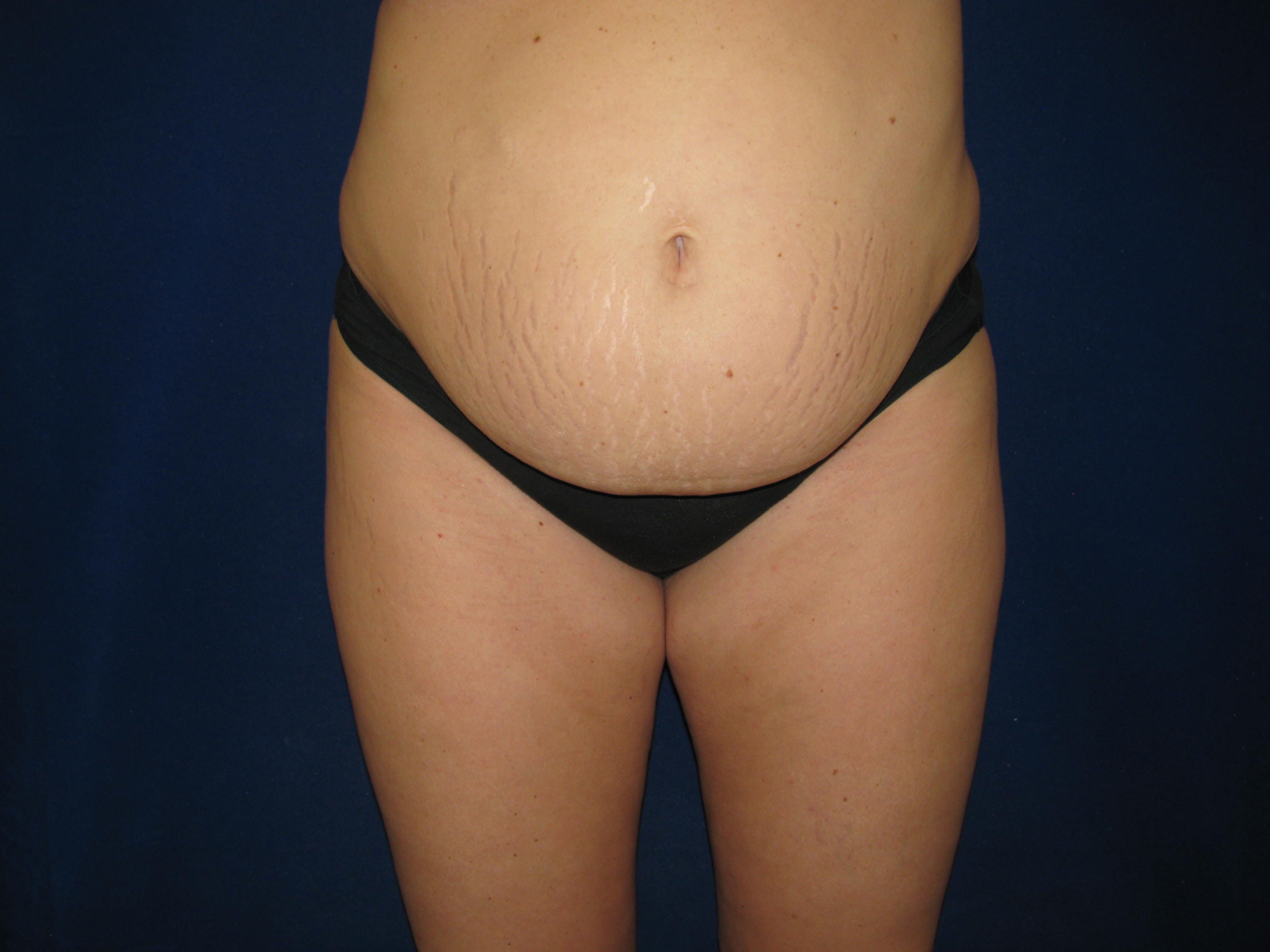 Abdominoplasty Before and After | LV Plastic Surgery