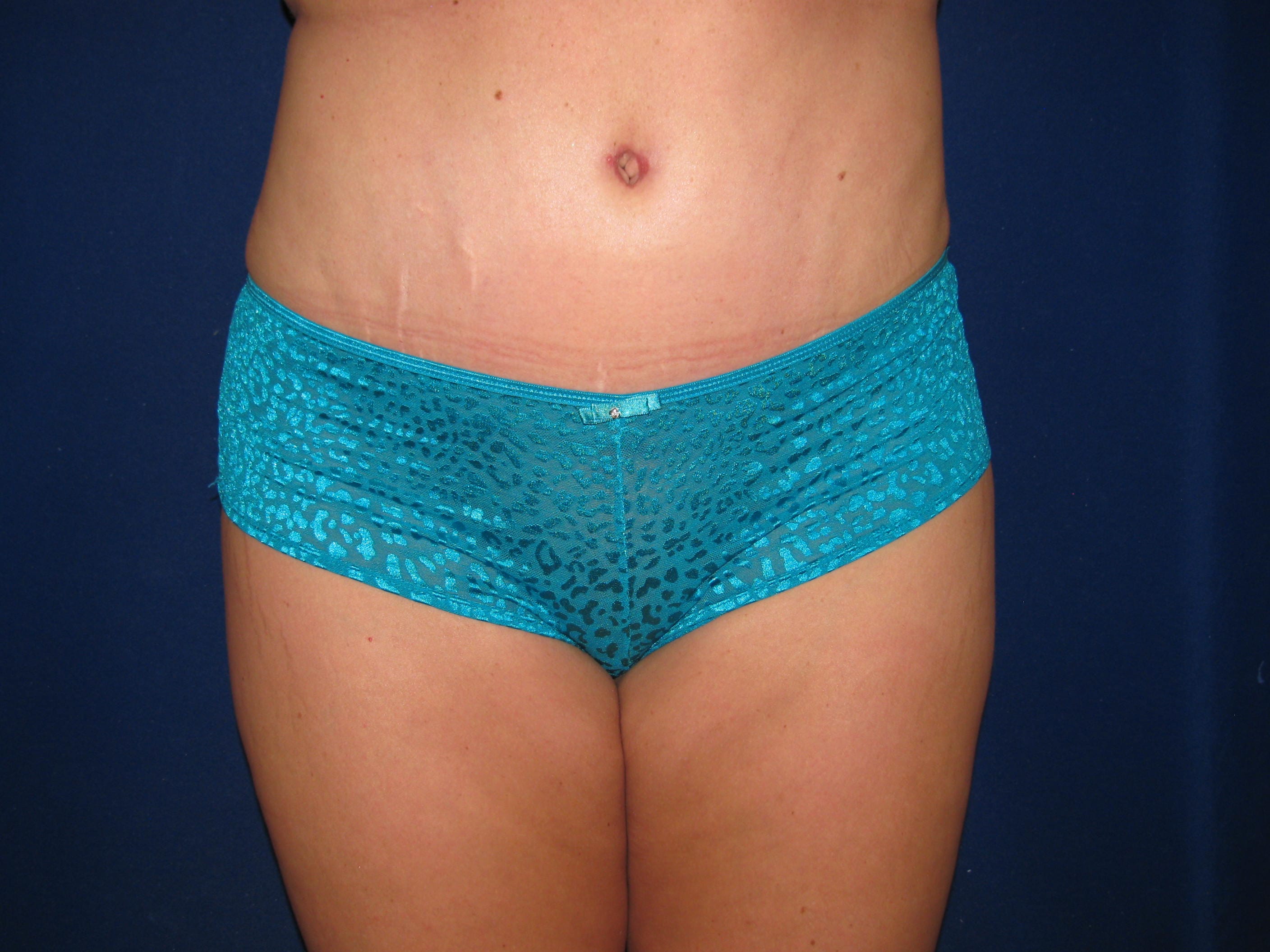 Abdominoplasty Before and After | LV Plastic Surgery