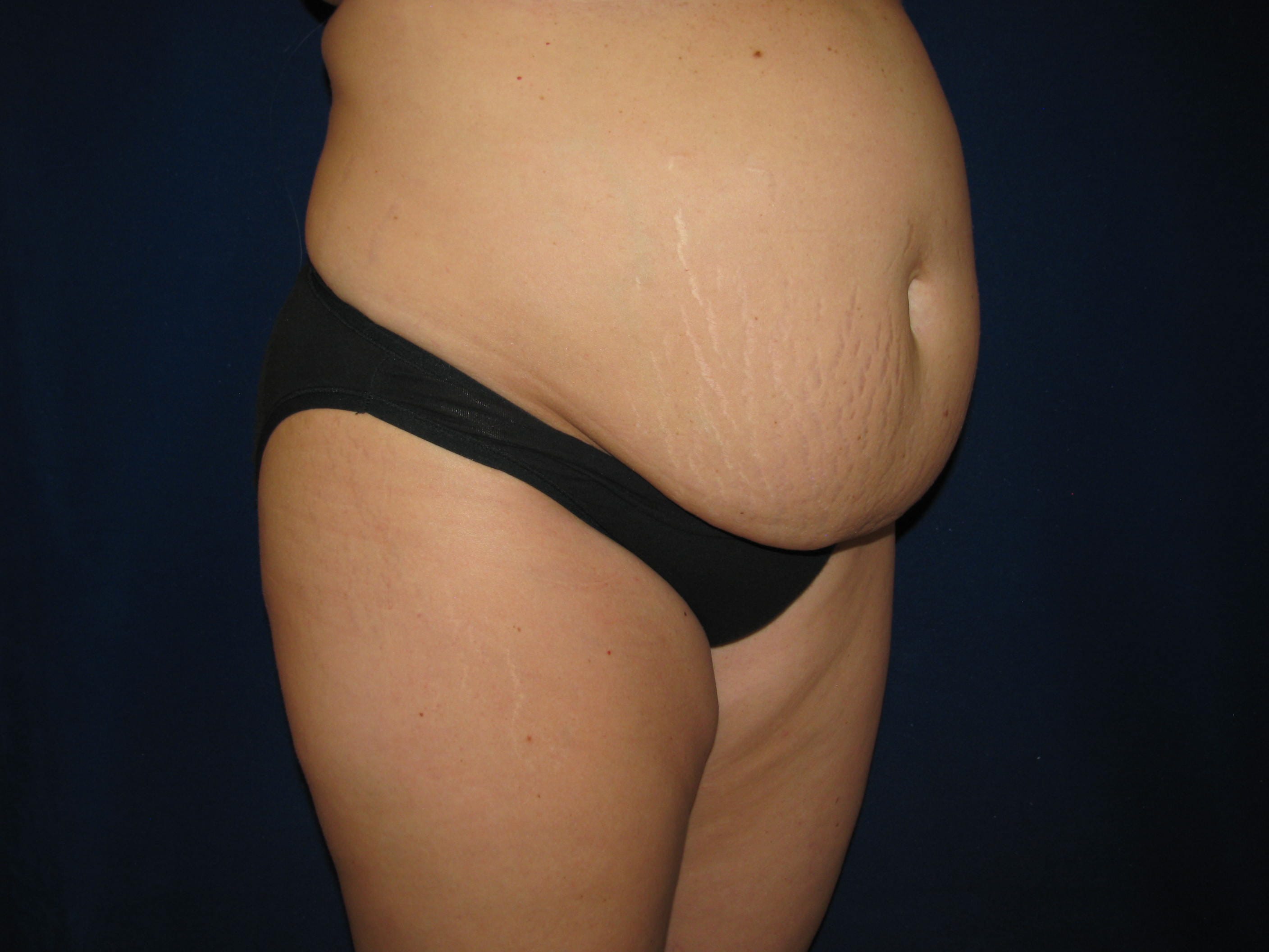 Abdominoplasty Before and After | LV Plastic Surgery