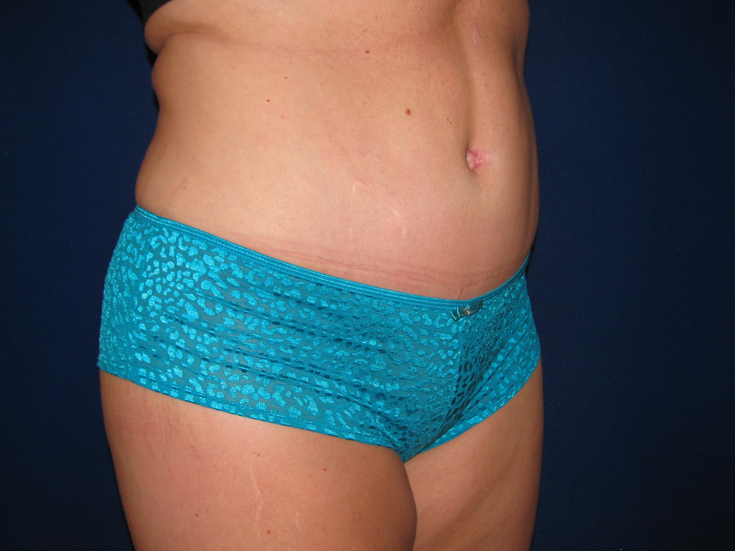 Abdominoplasty Before and After | LV Plastic Surgery