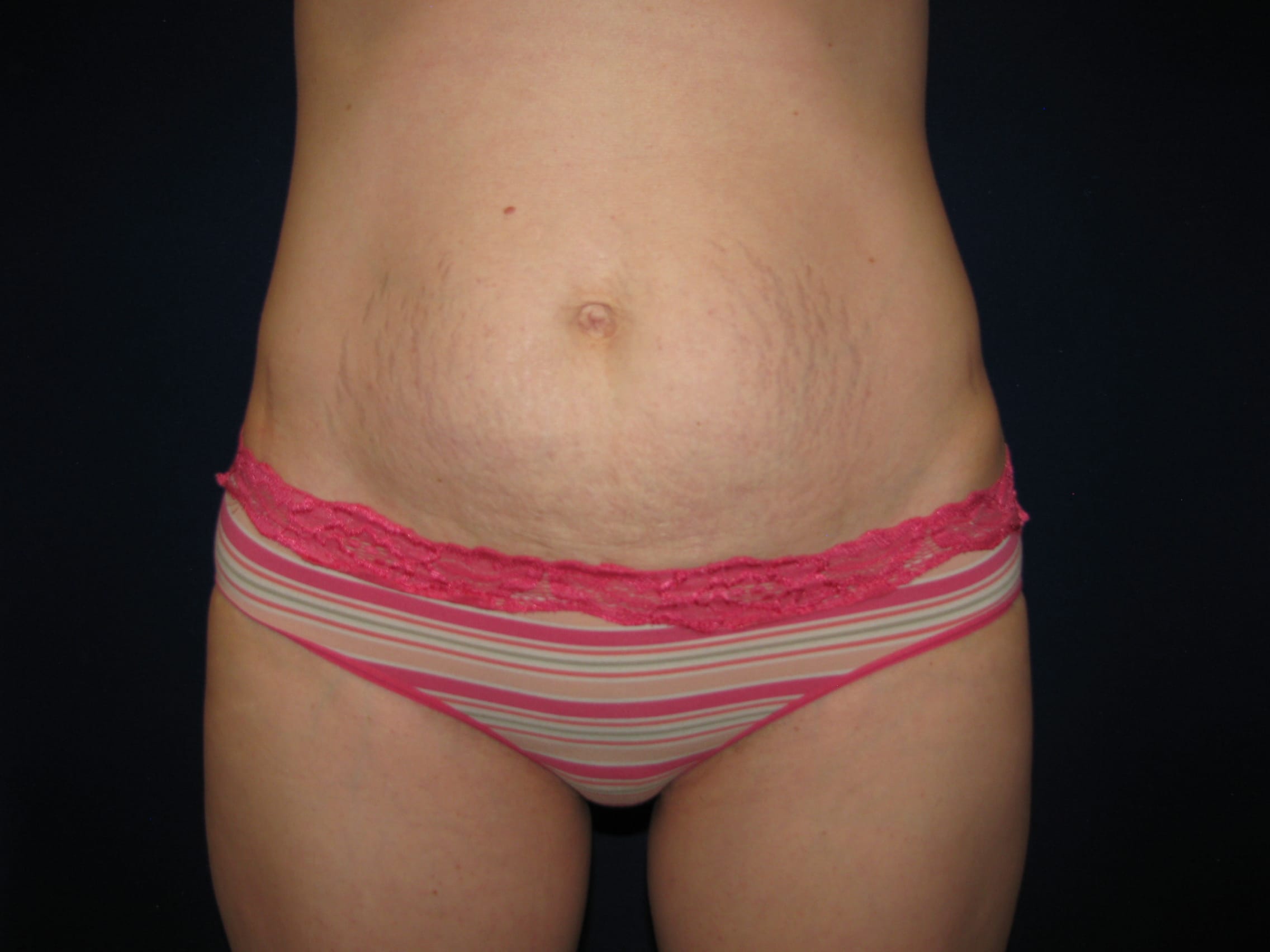 Abdominoplasty Before and After | LV Plastic Surgery