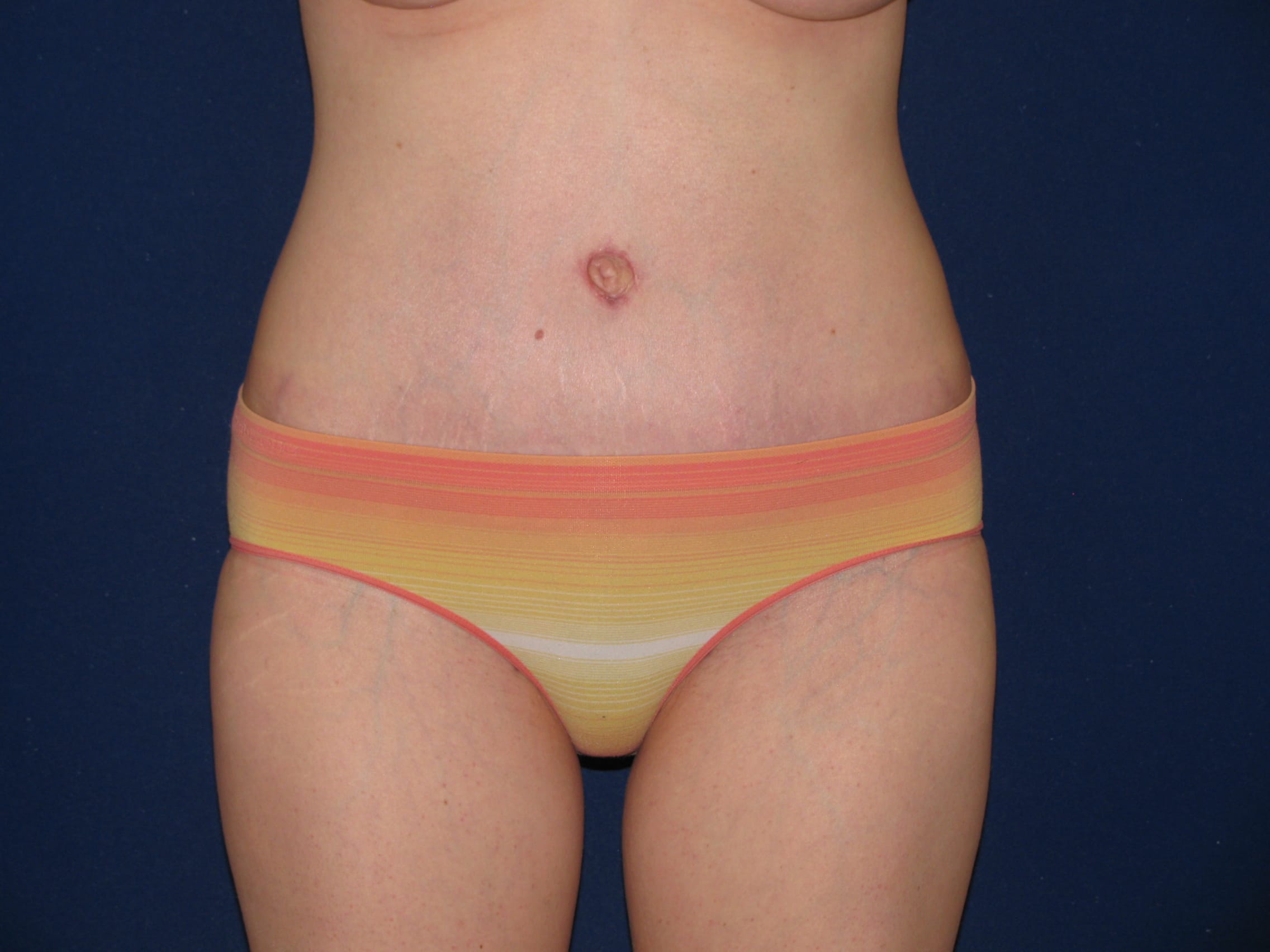 Abdominoplasty Before and After | LV Plastic Surgery