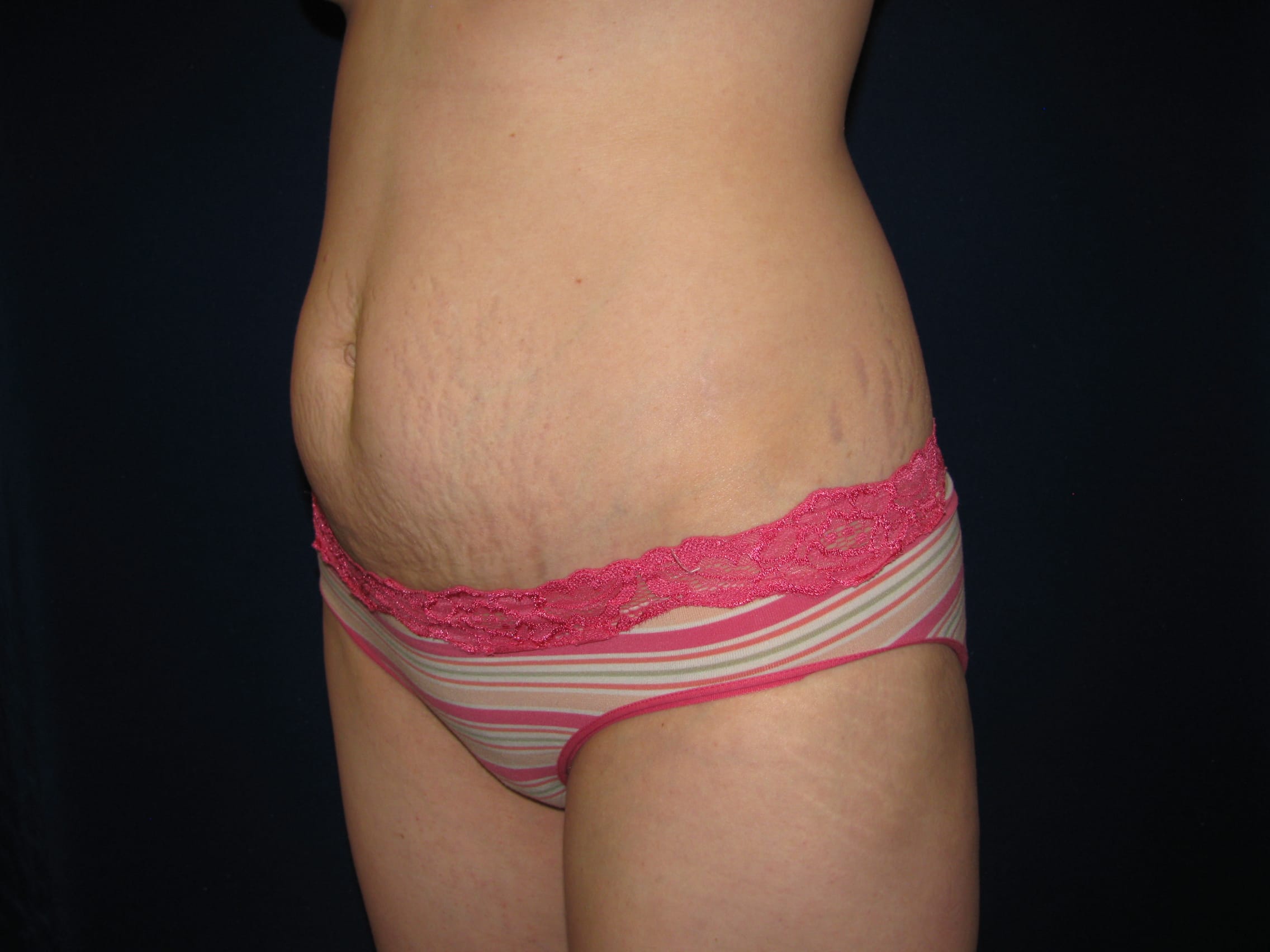 Abdominoplasty Before and After | LV Plastic Surgery