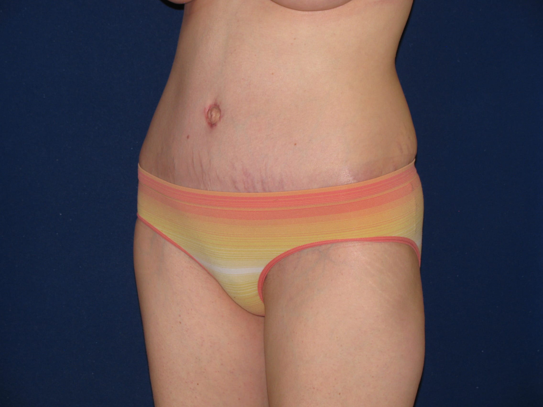 Abdominoplasty Before and After | LV Plastic Surgery