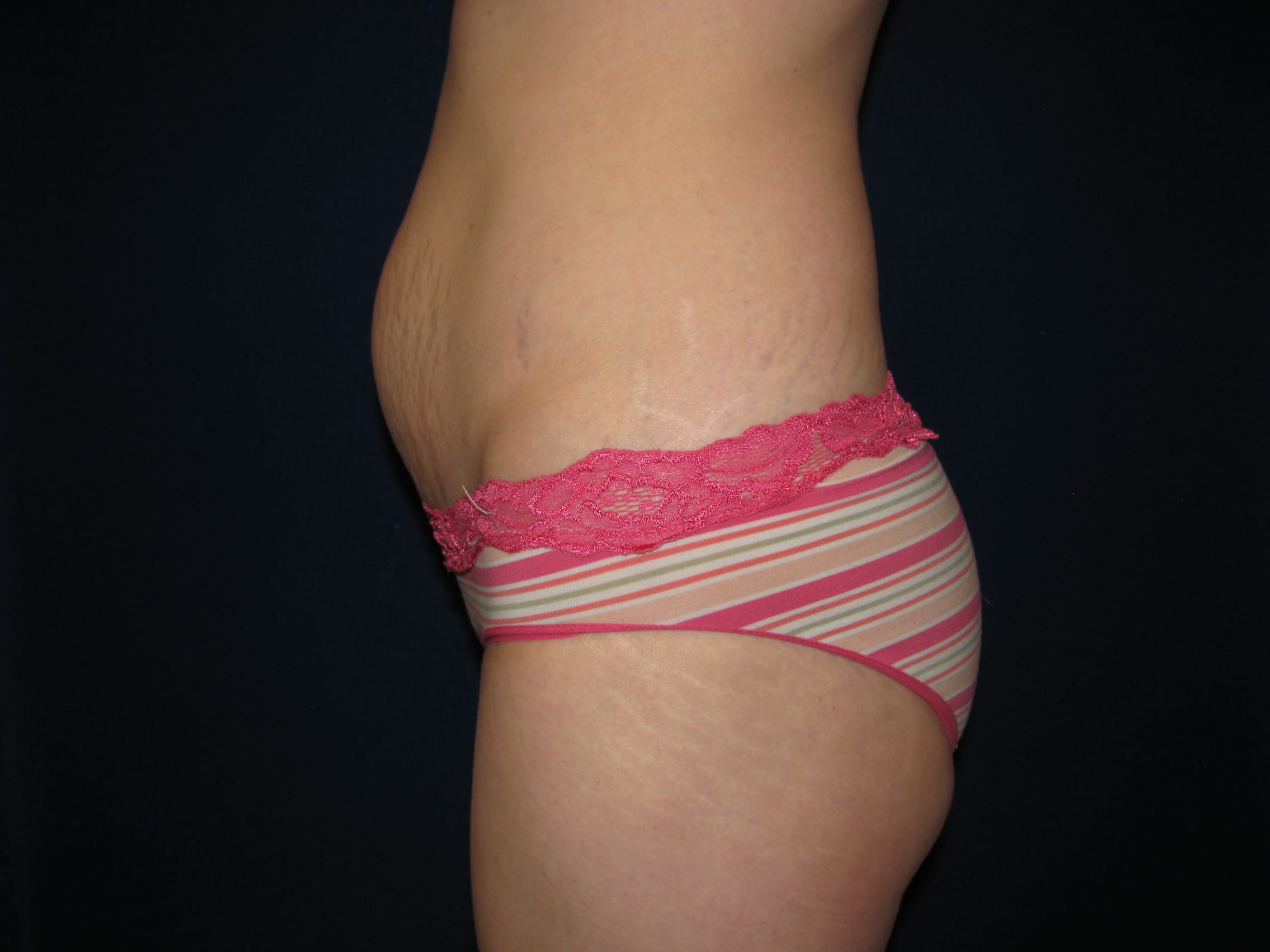 Abdominoplasty Before and After | LV Plastic Surgery