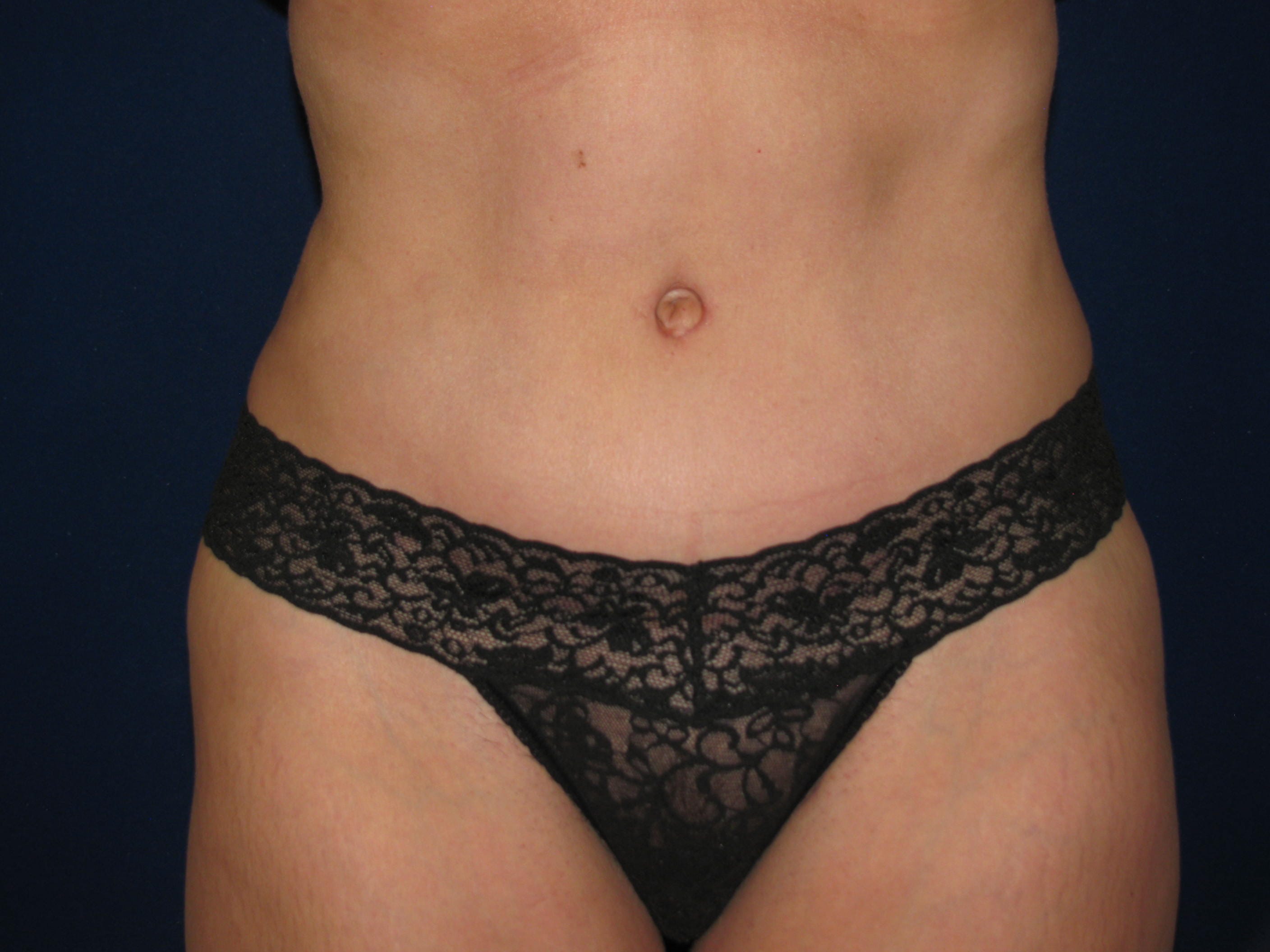 Abdominoplasty Before and After | LV Plastic Surgery