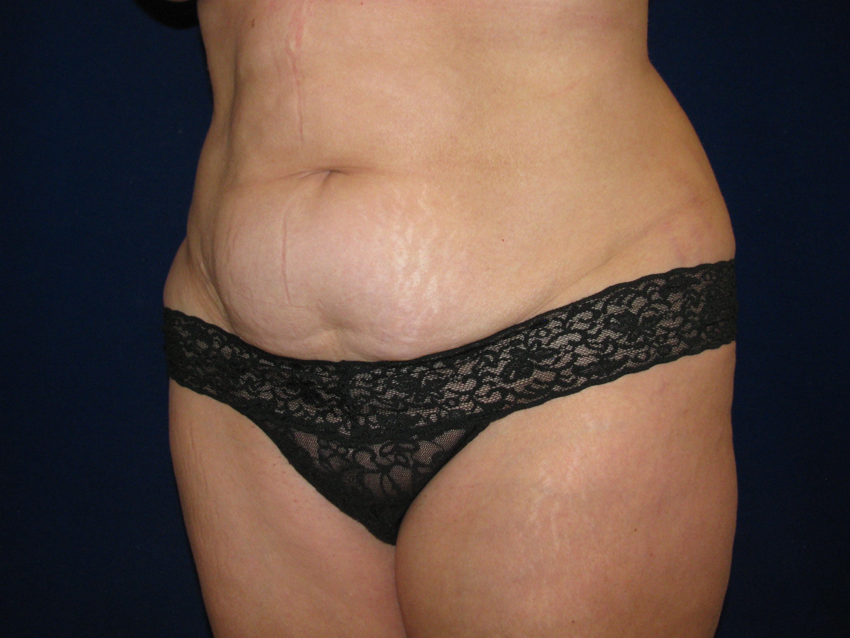 Abdominoplasty Before and After | LV Plastic Surgery