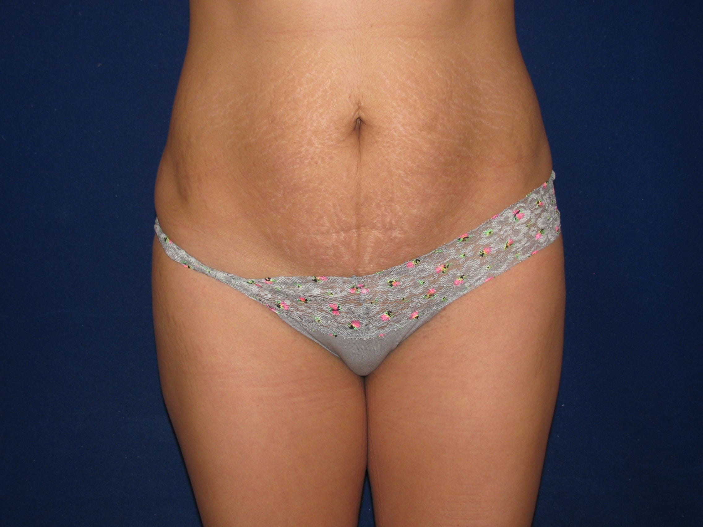 Abdominoplasty Before and After | LV Plastic Surgery