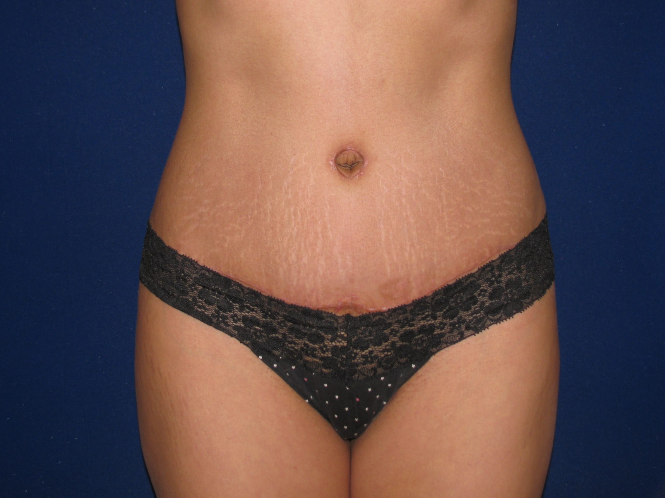 Abdominoplasty Before and After | LV Plastic Surgery