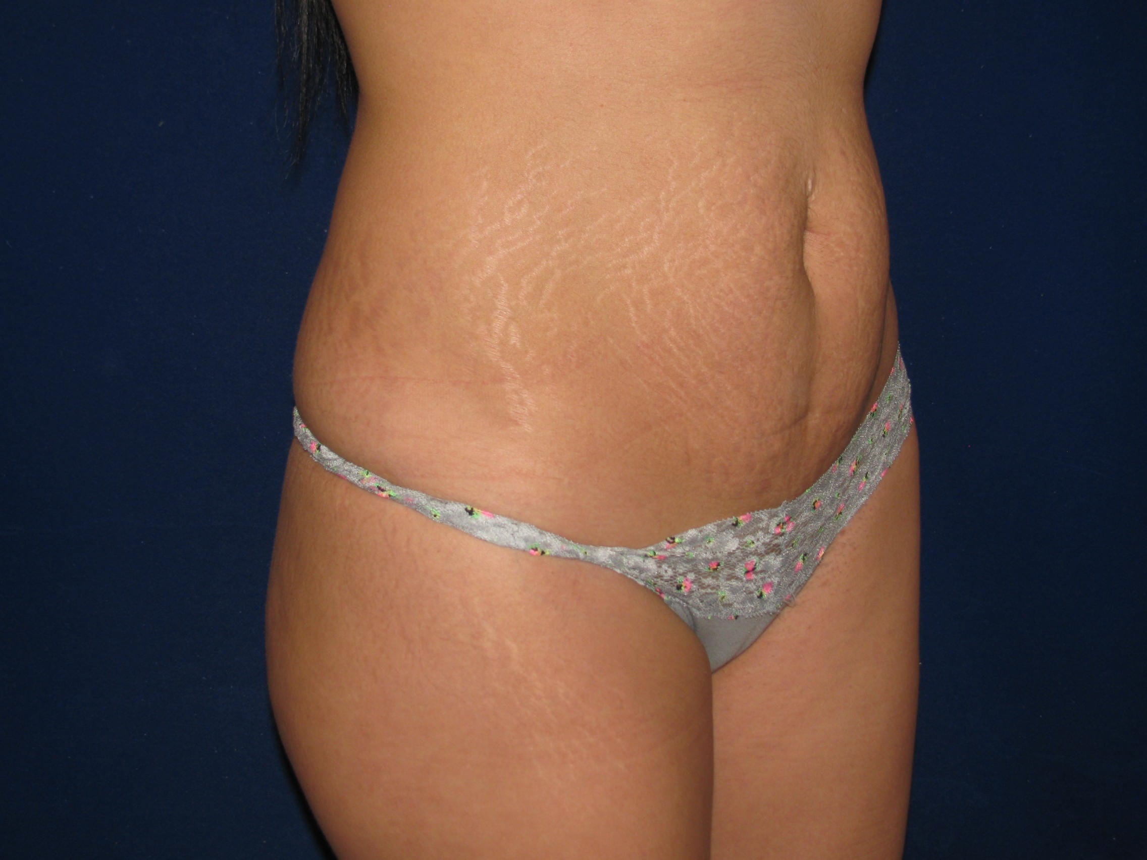 Abdominoplasty Before and After | LV Plastic Surgery