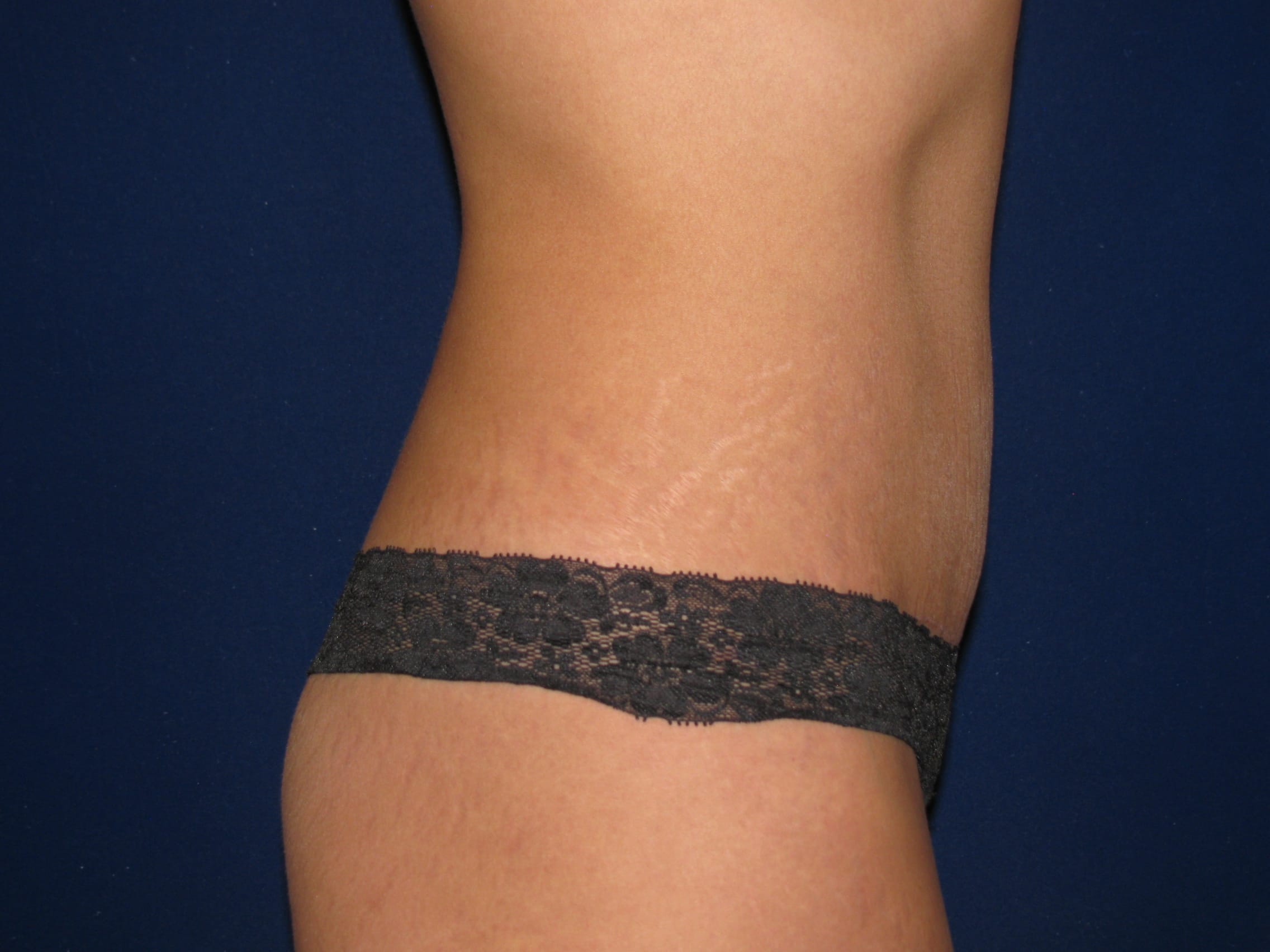 Abdominoplasty Before and After | LV Plastic Surgery