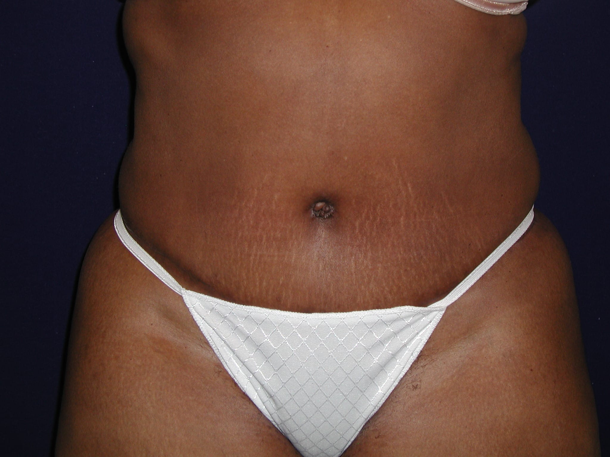 Abdominoplasty Before and After | LV Plastic Surgery