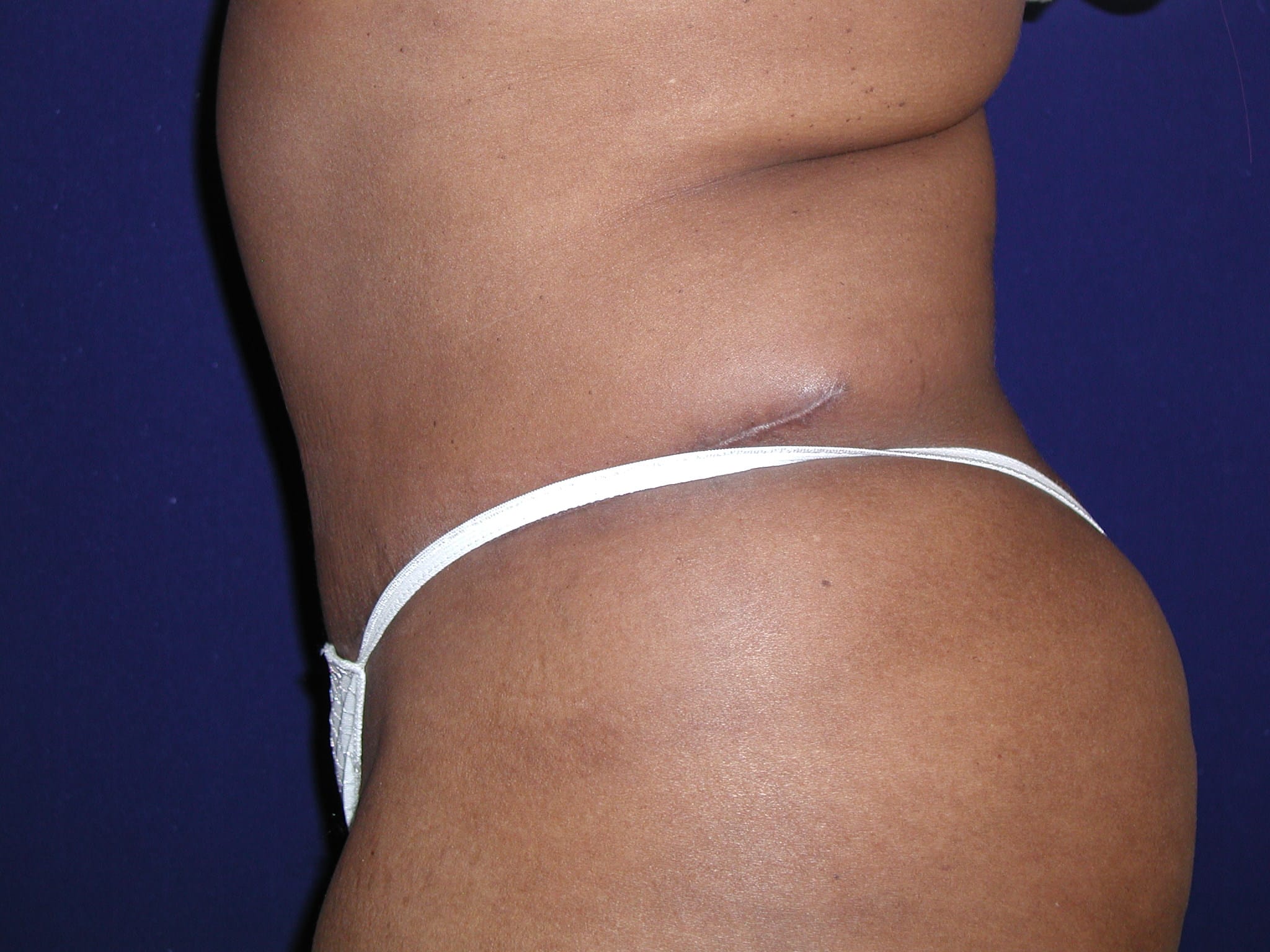 Abdominoplasty Before and After | LV Plastic Surgery