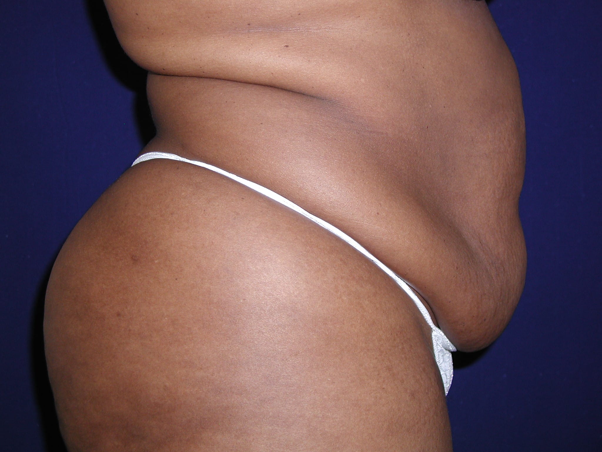 Abdominoplasty Before and After | LV Plastic Surgery