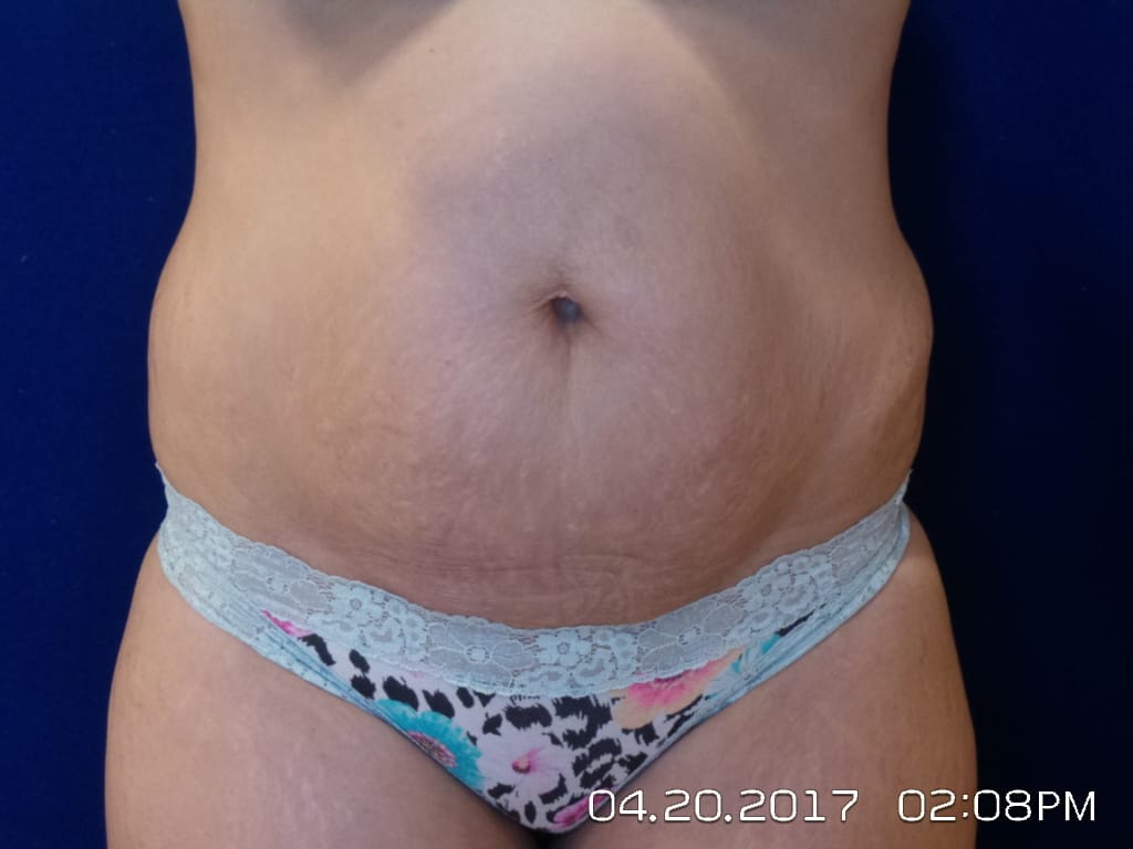 Abdominoplasty Before and After | LV Plastic Surgery