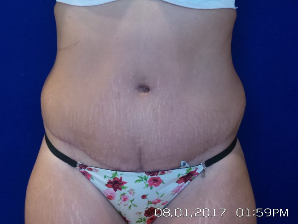 Abdominoplasty Before and After | LV Plastic Surgery