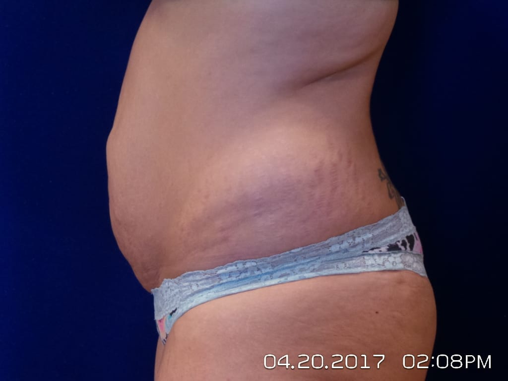 Abdominoplasty Before and After | LV Plastic Surgery