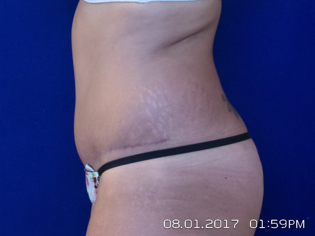 Abdominoplasty Before and After | LV Plastic Surgery