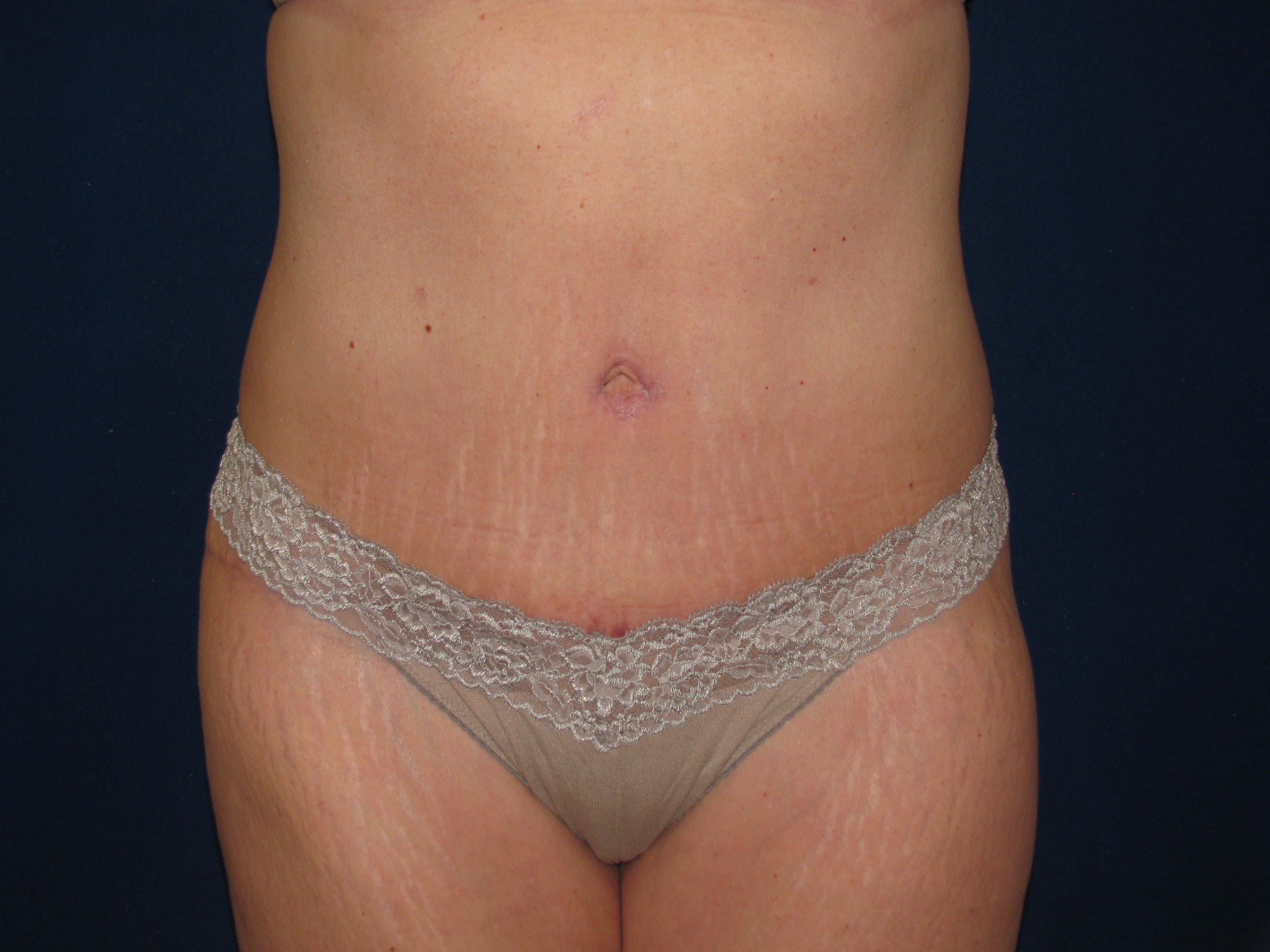 Abdominoplasty Before and After | LV Plastic Surgery