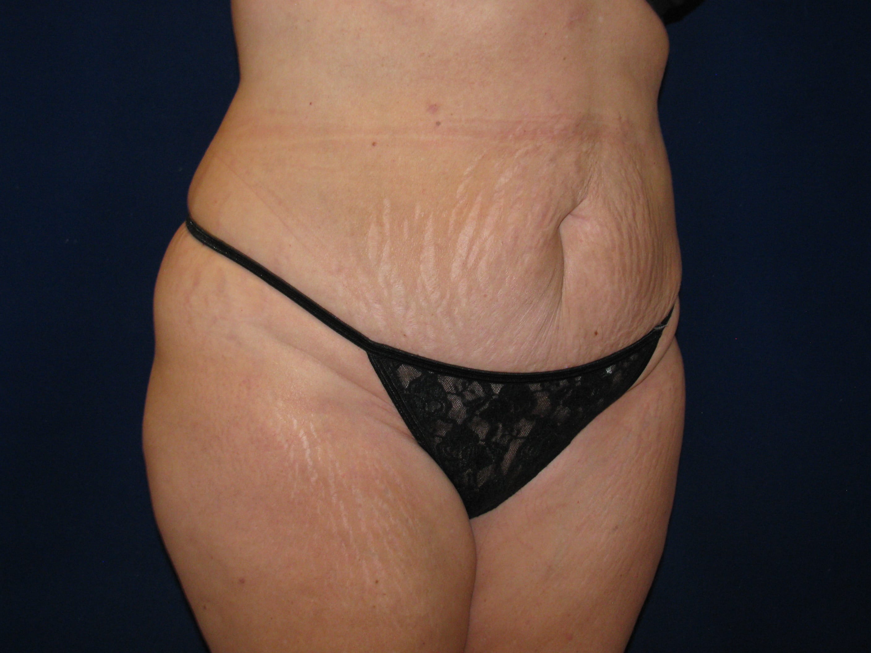 Abdominoplasty Before and After | LV Plastic Surgery