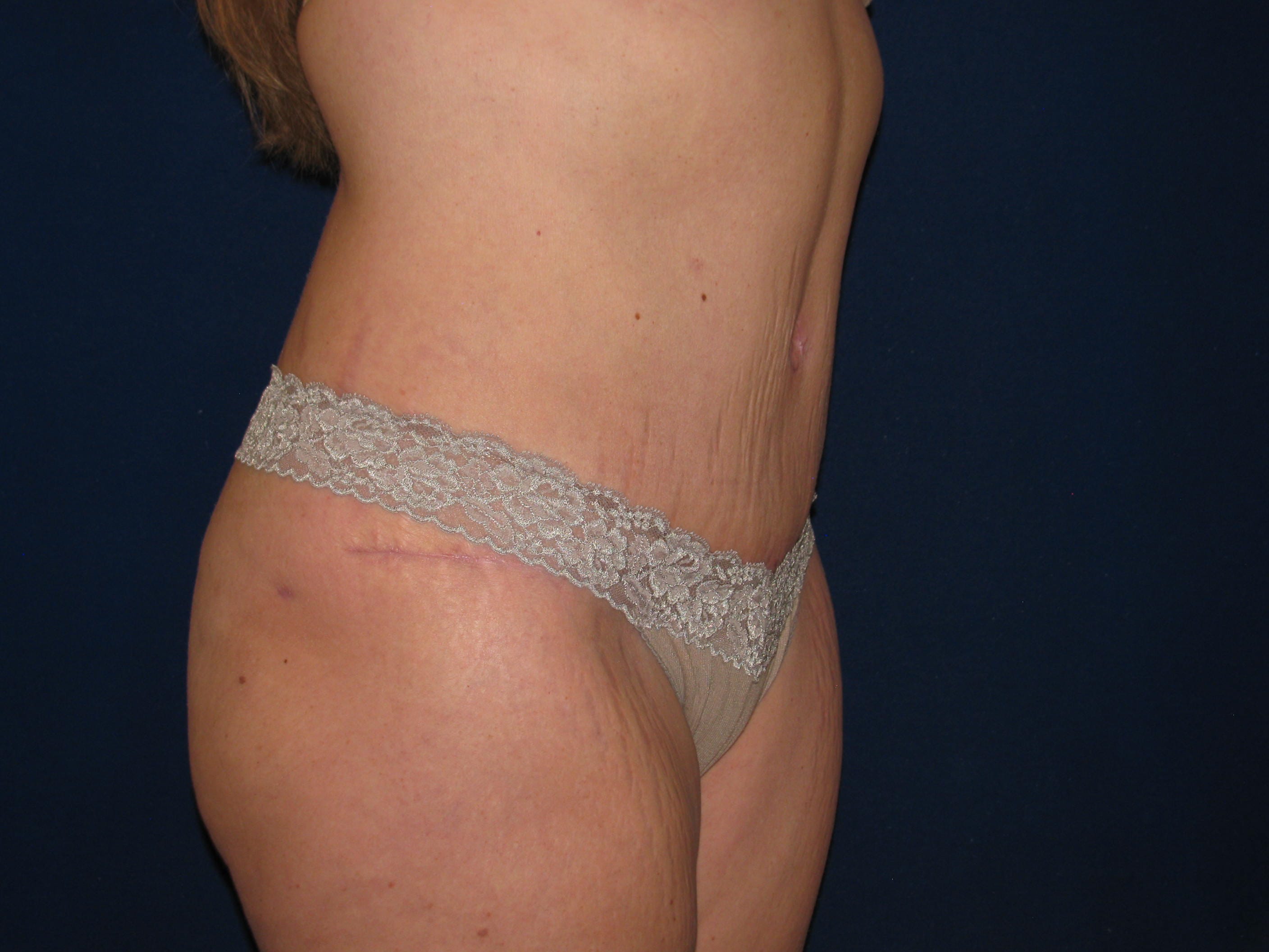 Abdominoplasty Before and After | LV Plastic Surgery