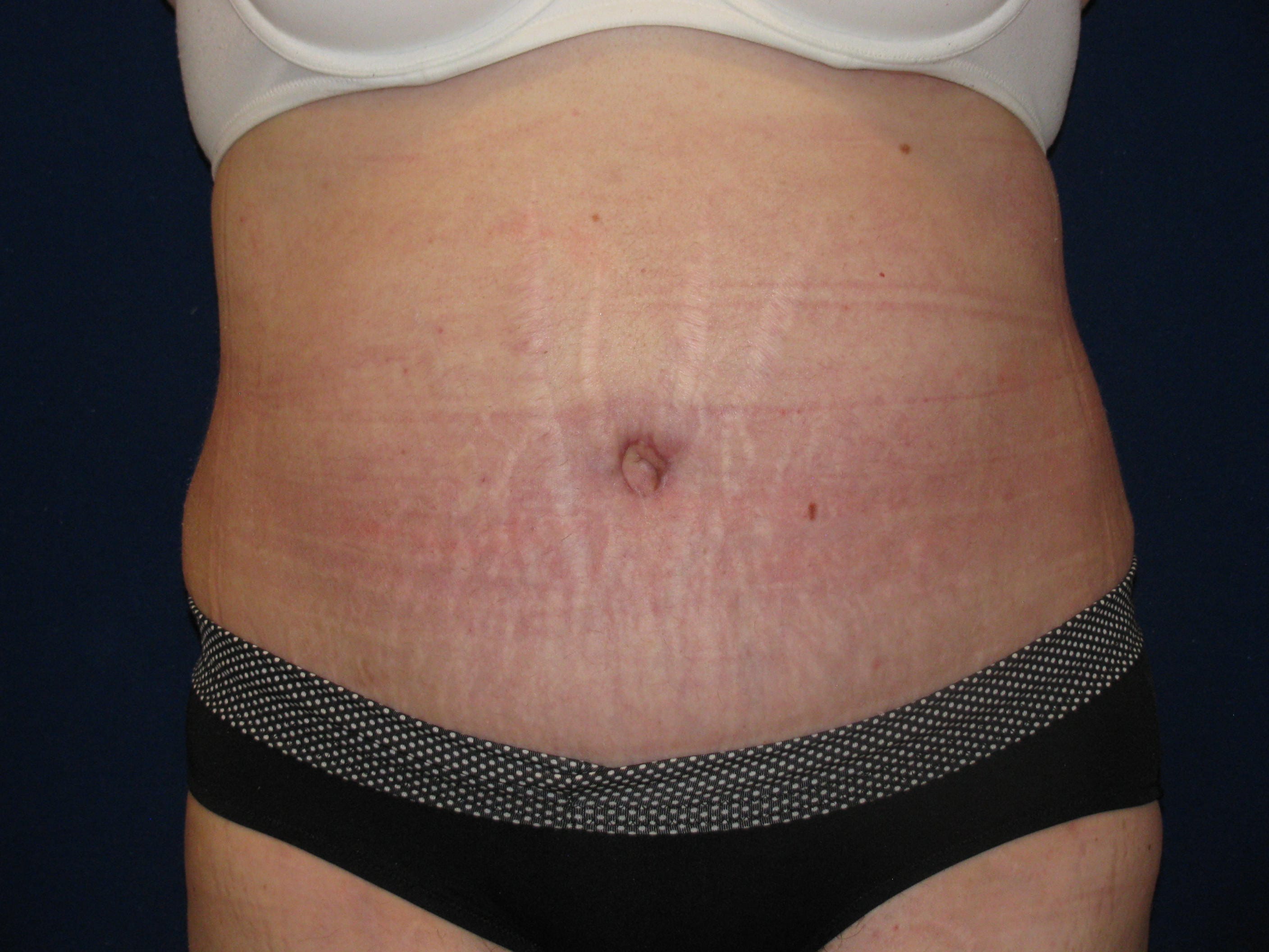 Abdominoplasty Before and After | LV Plastic Surgery