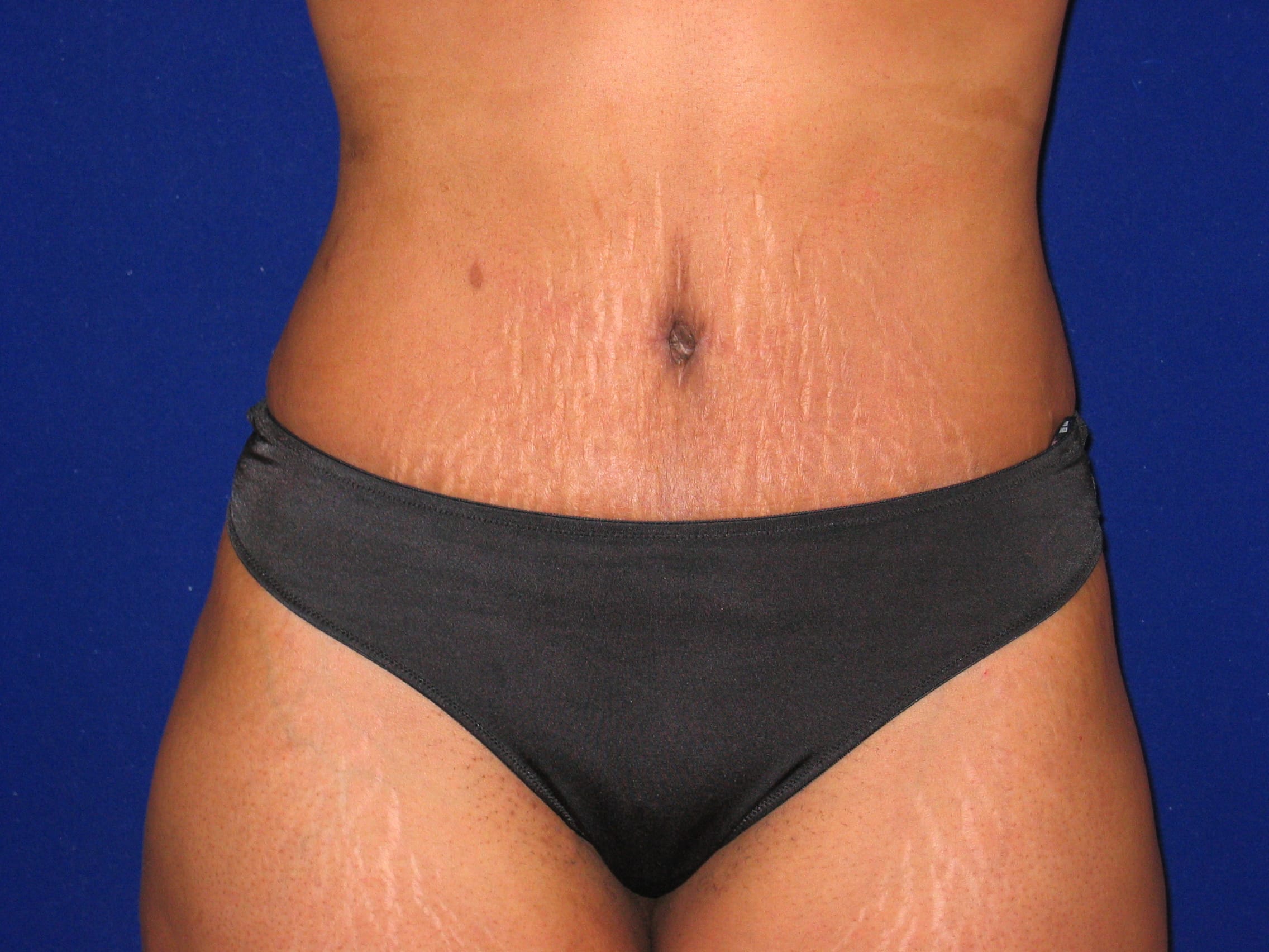 Abdominoplasty Before and After | LV Plastic Surgery