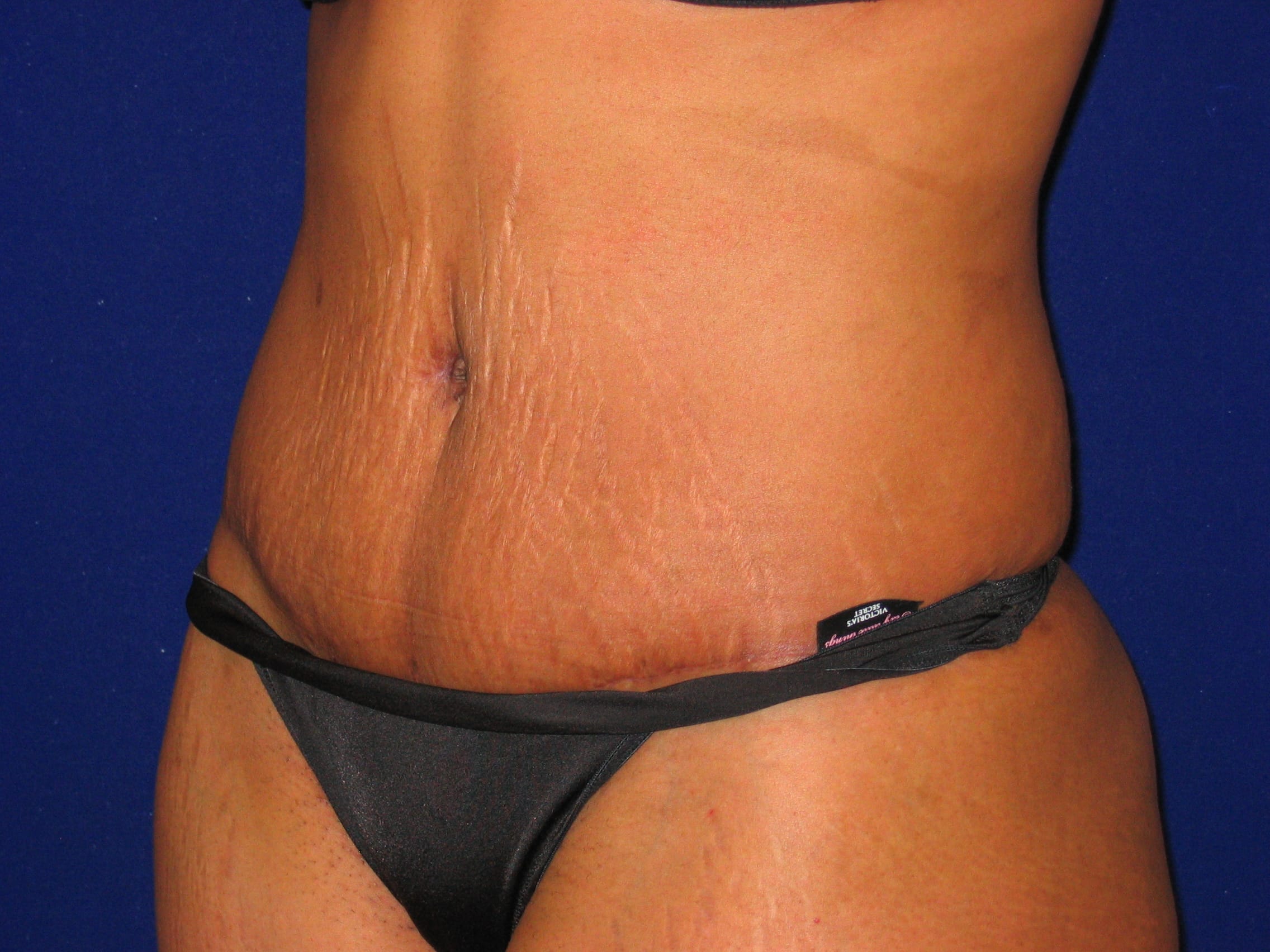 Abdominoplasty Before and After | LV Plastic Surgery