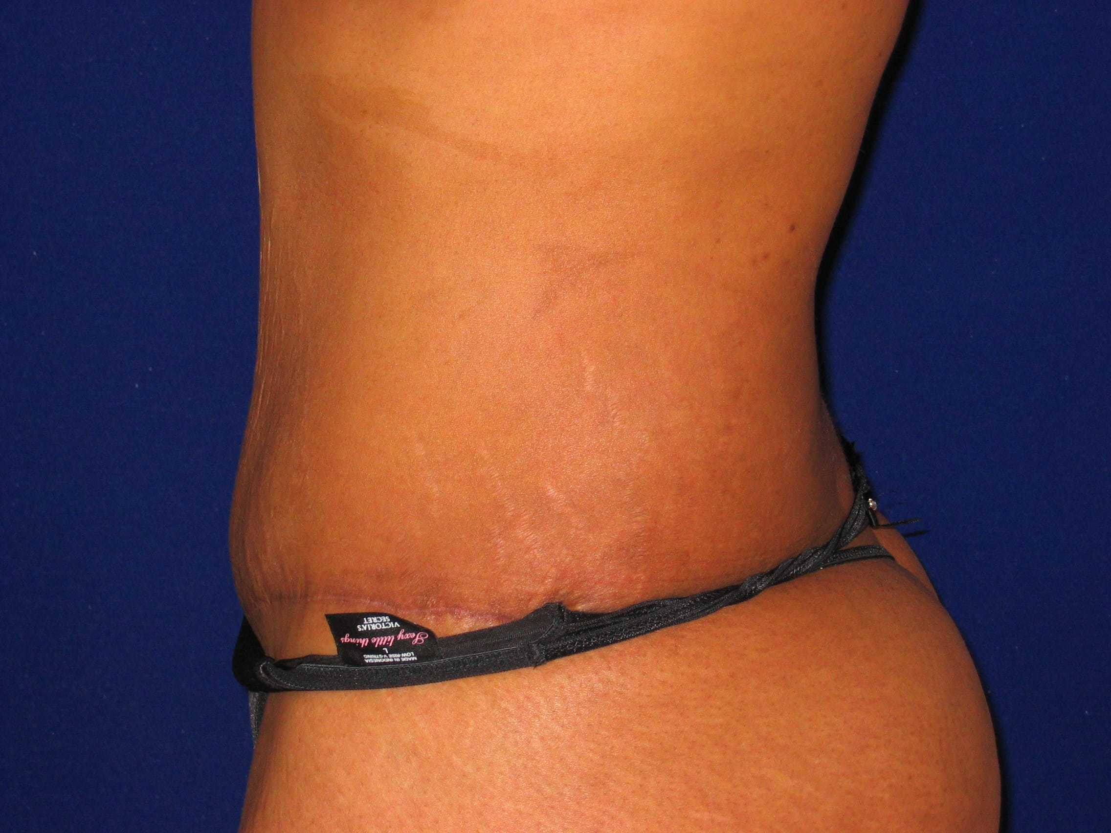 Abdominoplasty Before and After | LV Plastic Surgery