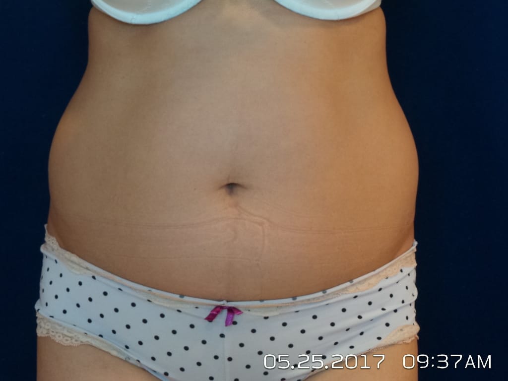 Abdominoplasty Before and After | LV Plastic Surgery