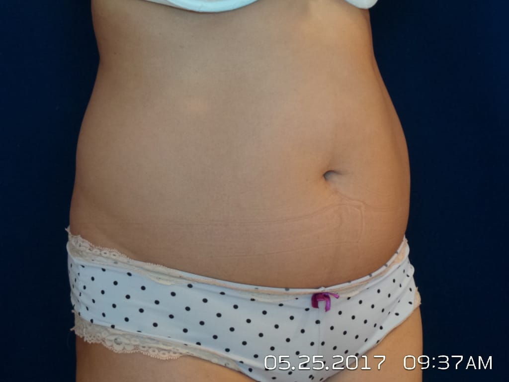 Abdominoplasty Before and After | LV Plastic Surgery