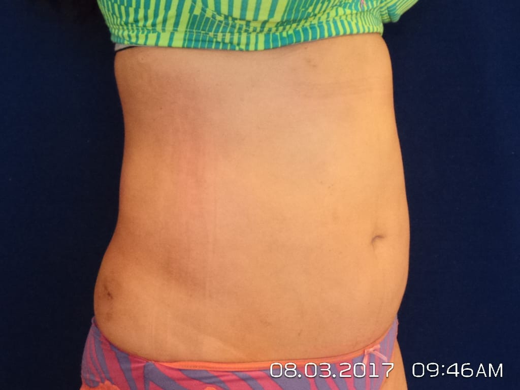 Abdominoplasty Before and After LV Plastic Surgery