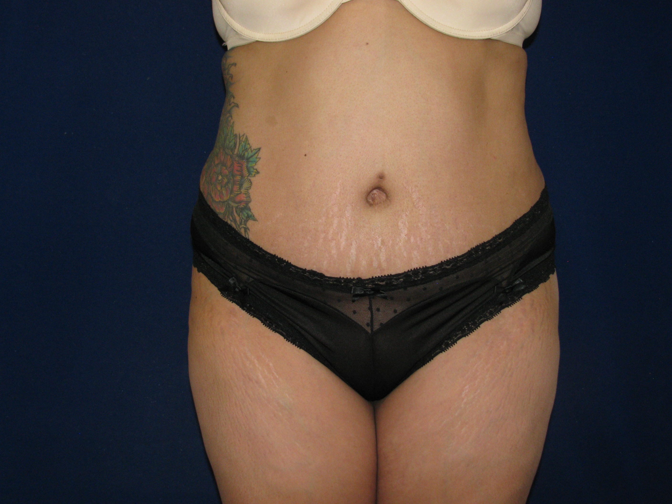 Abdominoplasty Before and After | LV Plastic Surgery