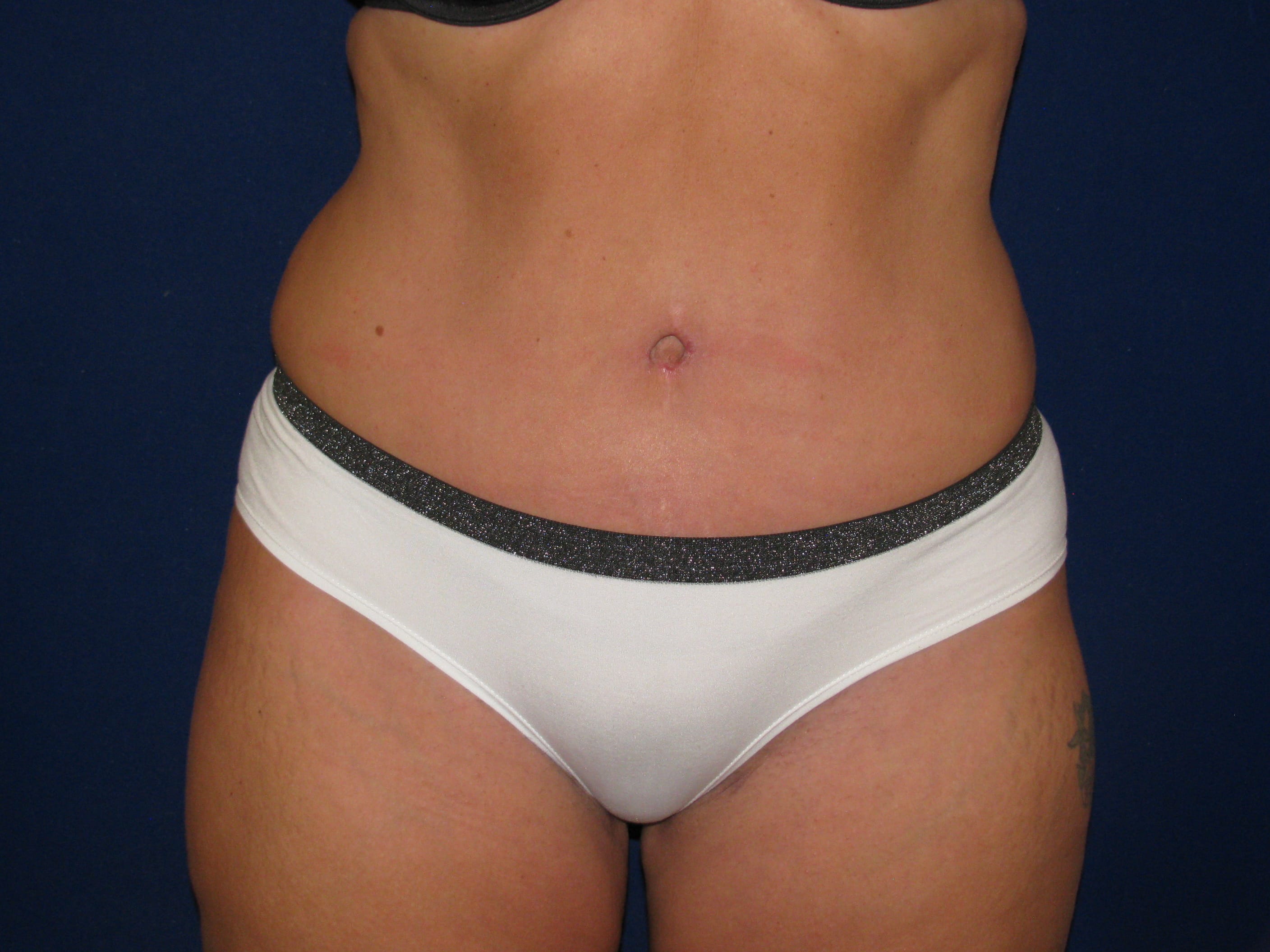 Abdominoplasty Before and After | LV Plastic Surgery