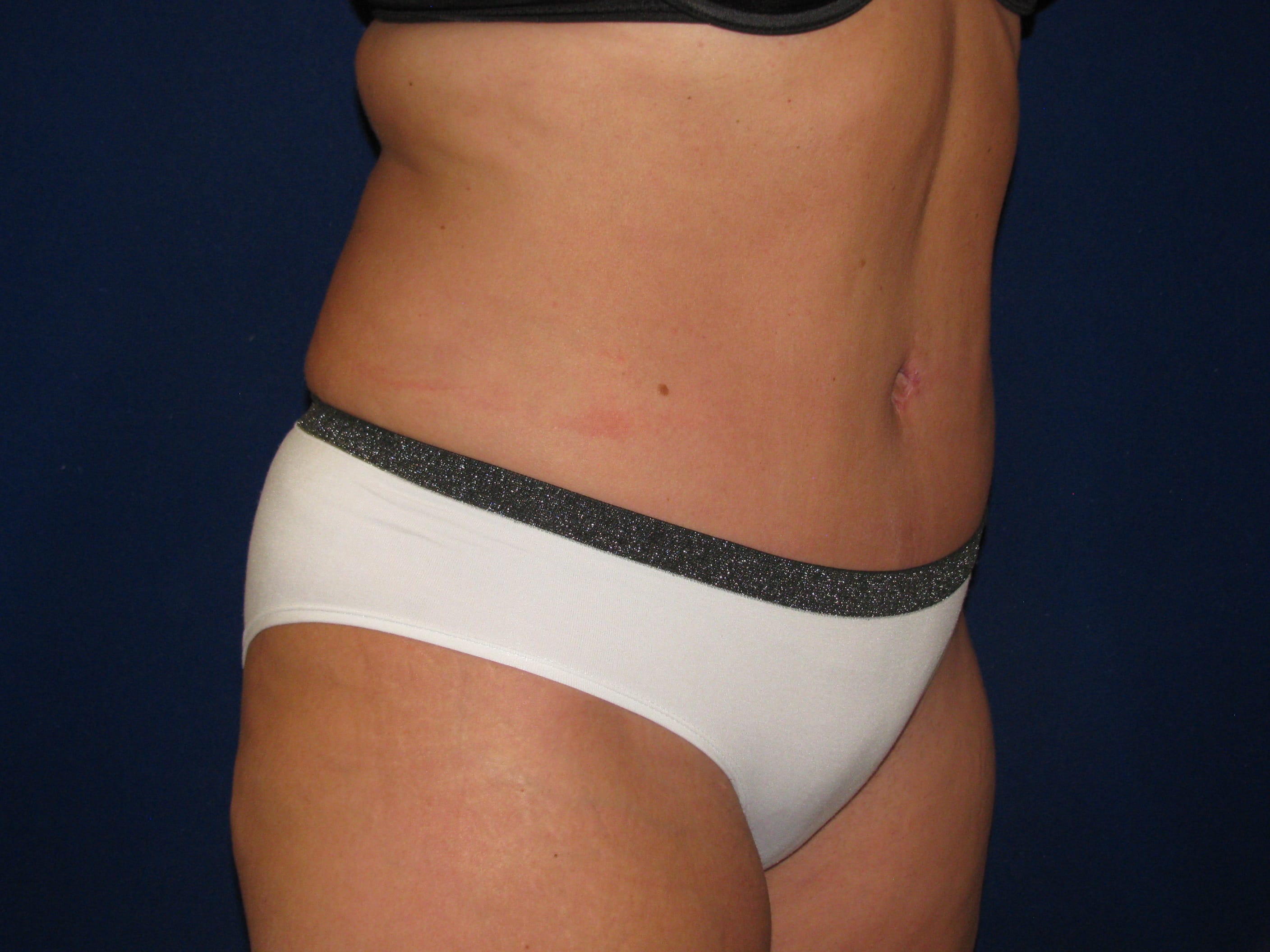 Abdominoplasty Before and After | LV Plastic Surgery