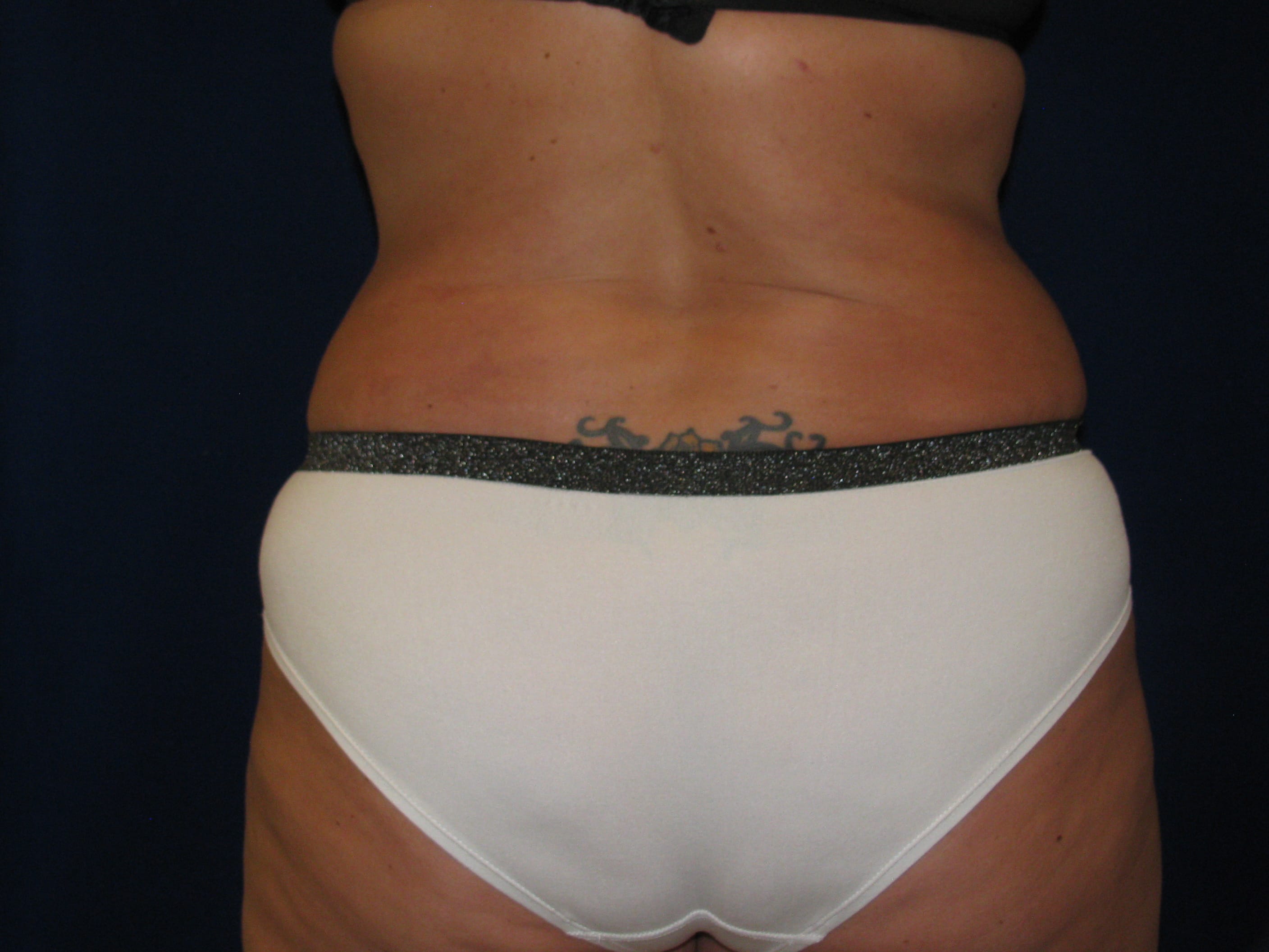 Abdominoplasty Before and After | LV Plastic Surgery