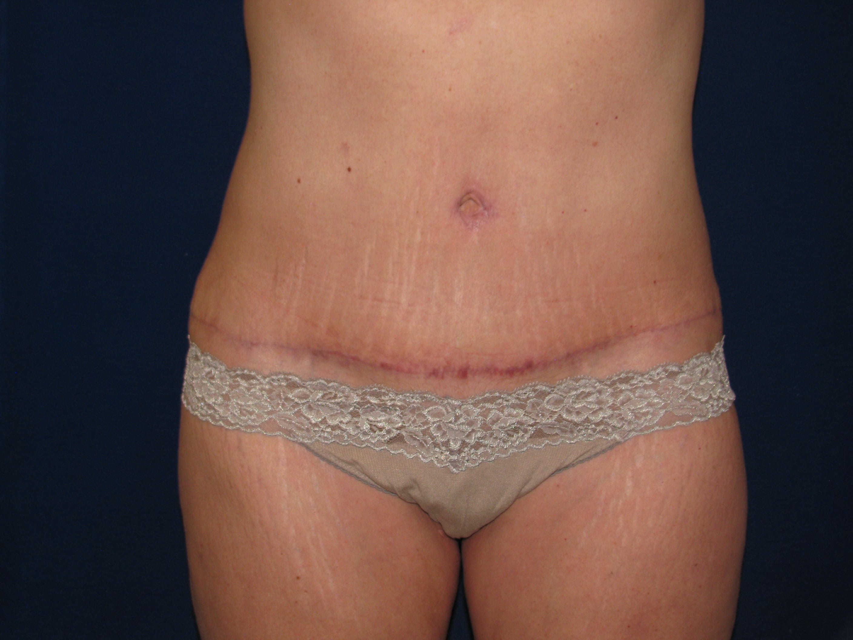 Abdominoplasty Before and After | LV Plastic Surgery