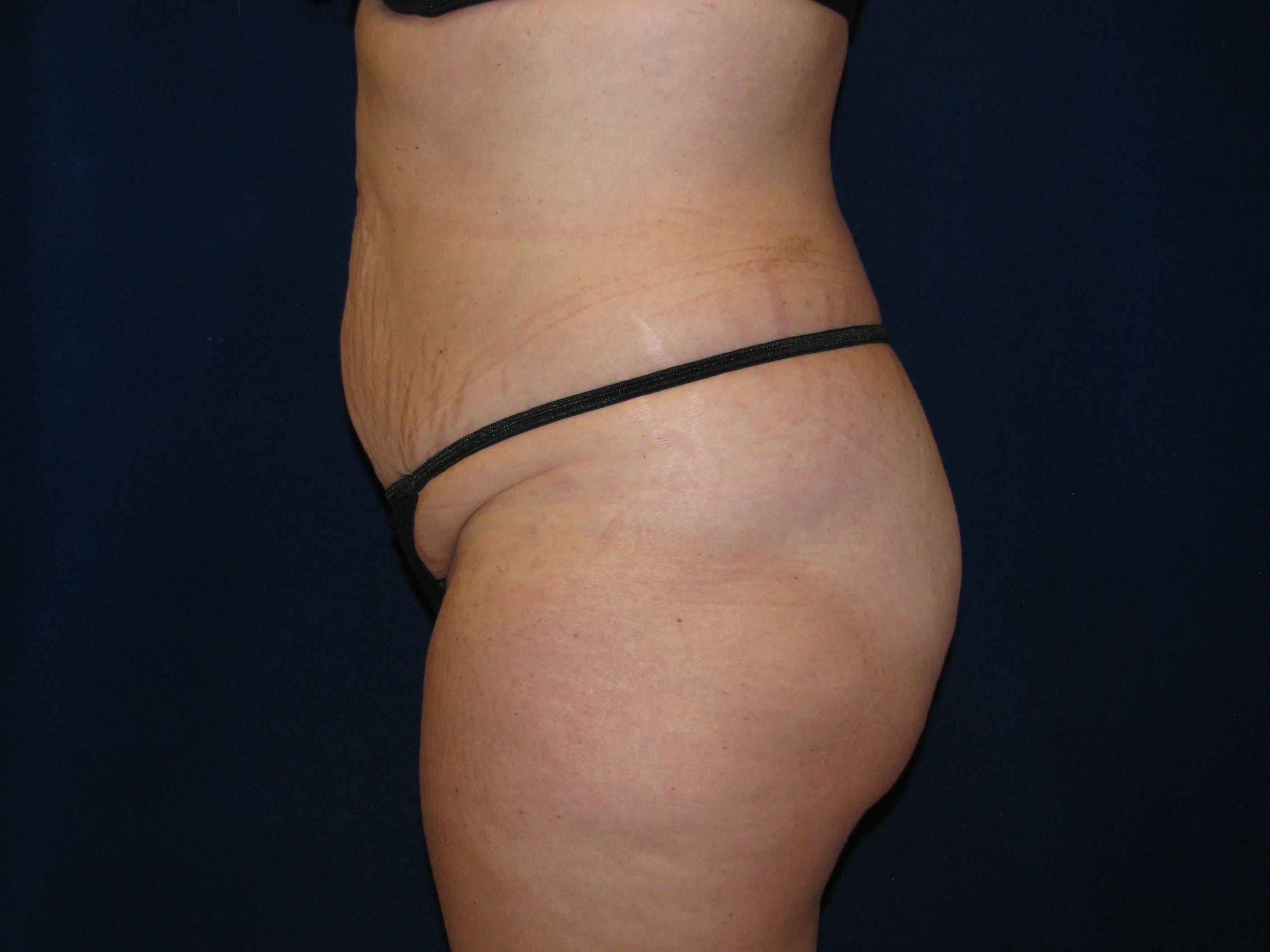 Abdominoplasty Before and After | LV Plastic Surgery