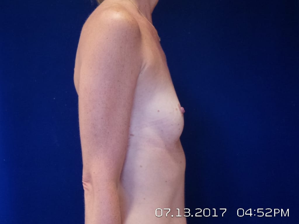 Breast Augmentation Before and After | LV Plastic Surgery