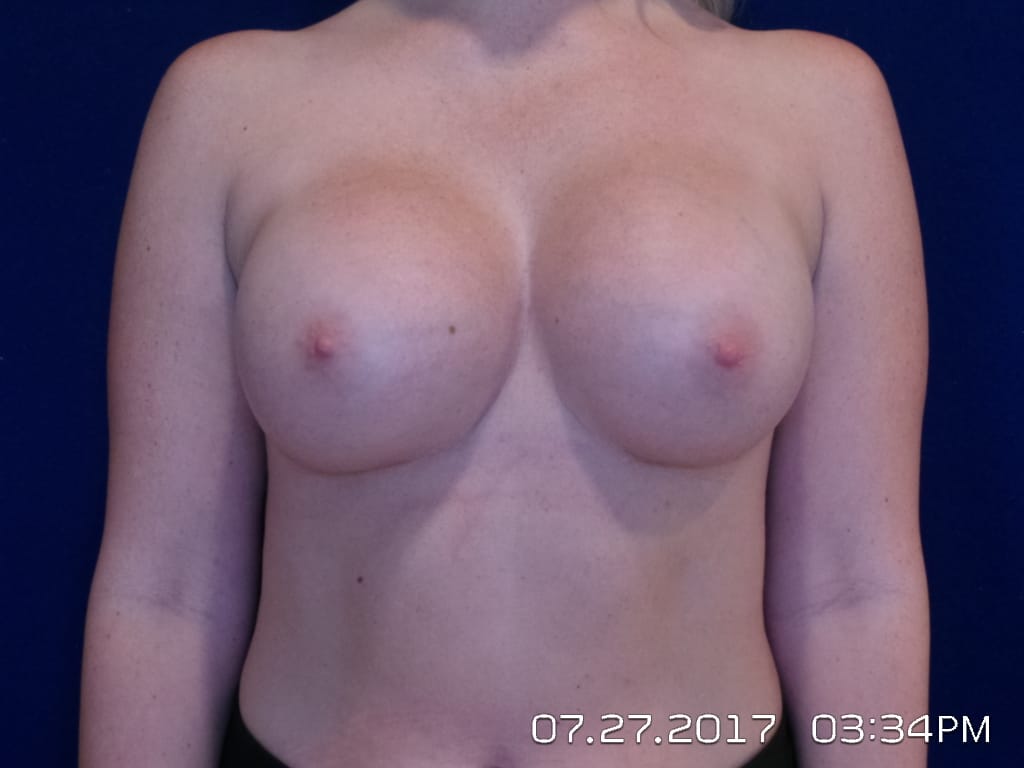 Breast Augmentation Before and After | LV Plastic Surgery