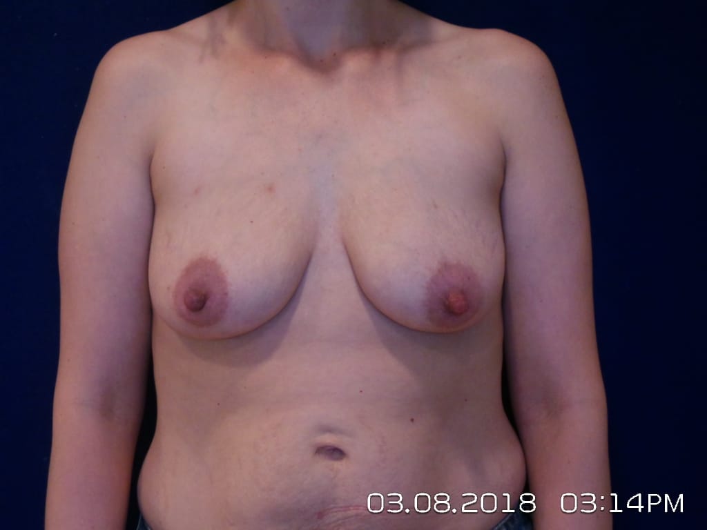 Breast Lift Before and After | LV Plastic Surgery