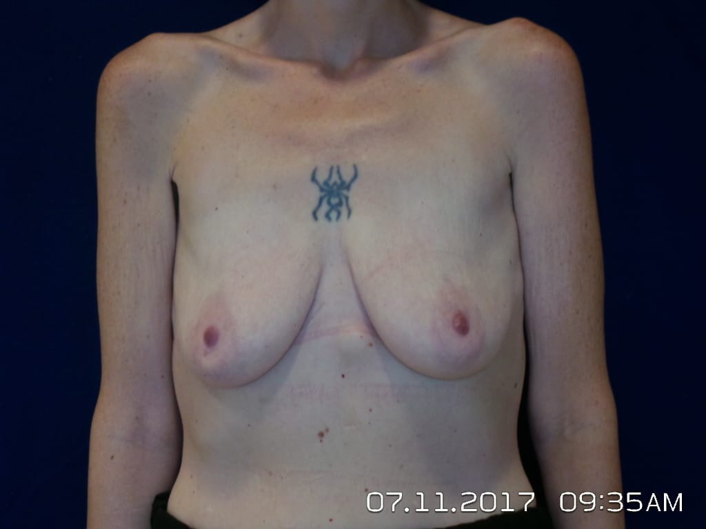 Breast Lift Before and After | LV Plastic Surgery