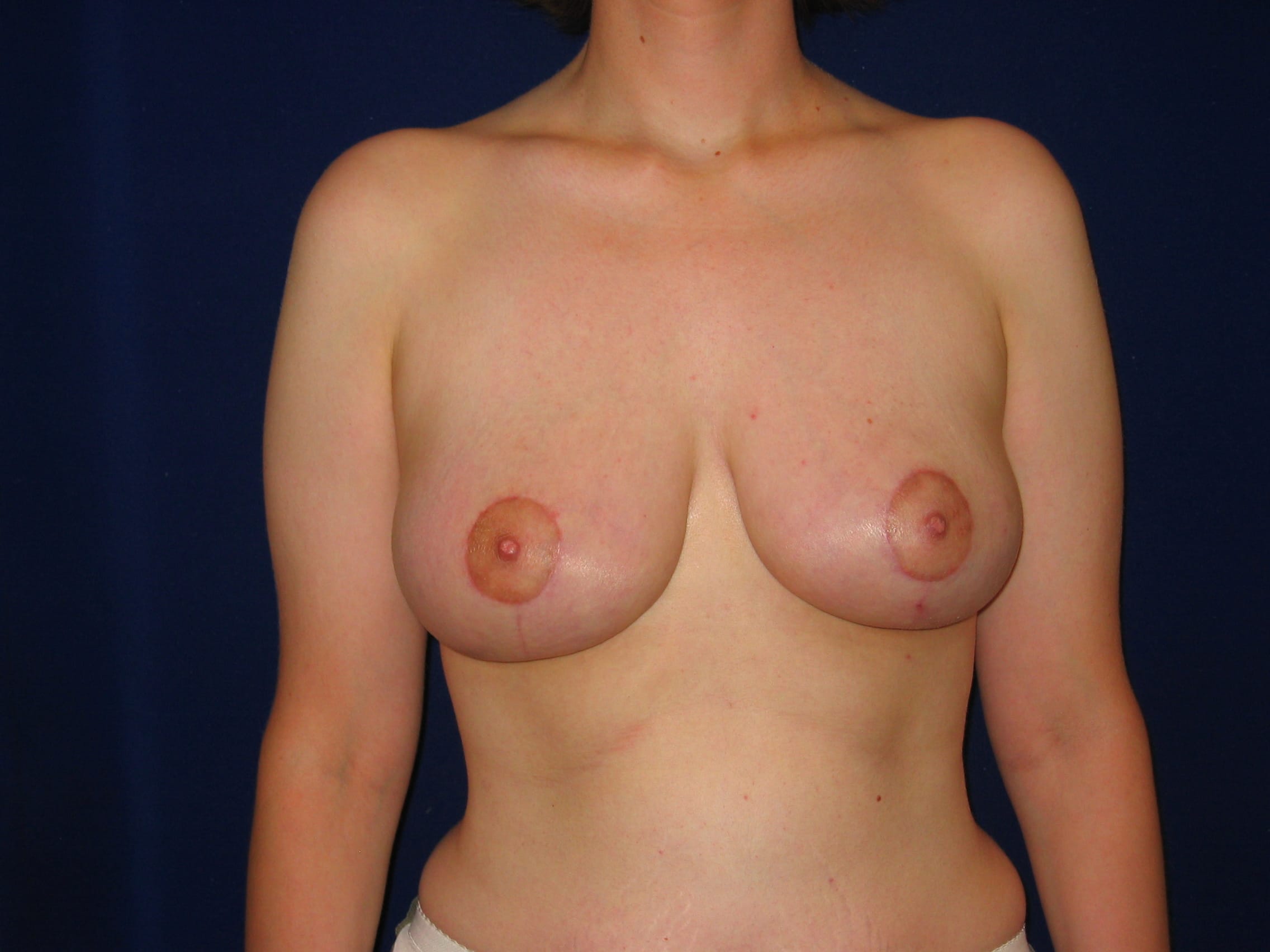 Breast Lift Before and After | LV Plastic Surgery