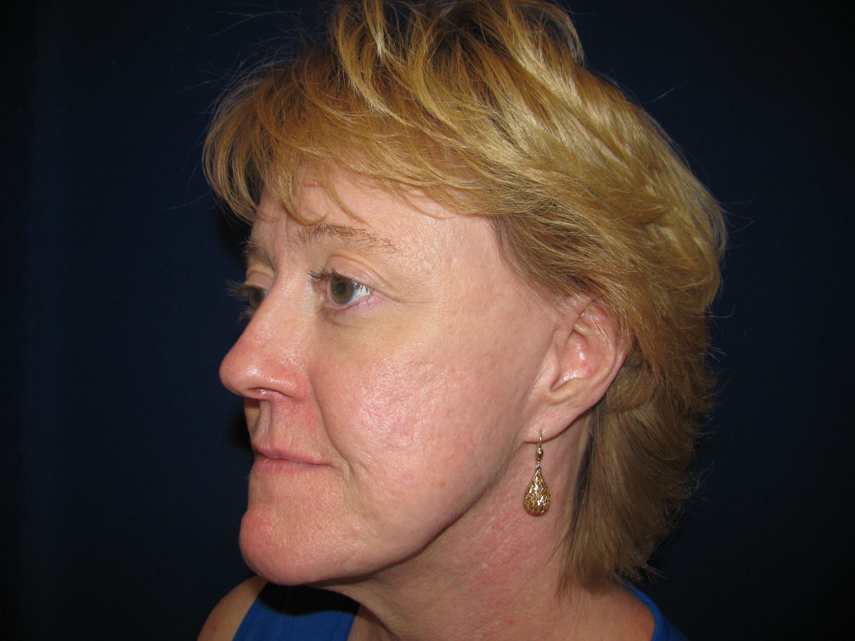 Facelift Before and After | LV Plastic Surgery