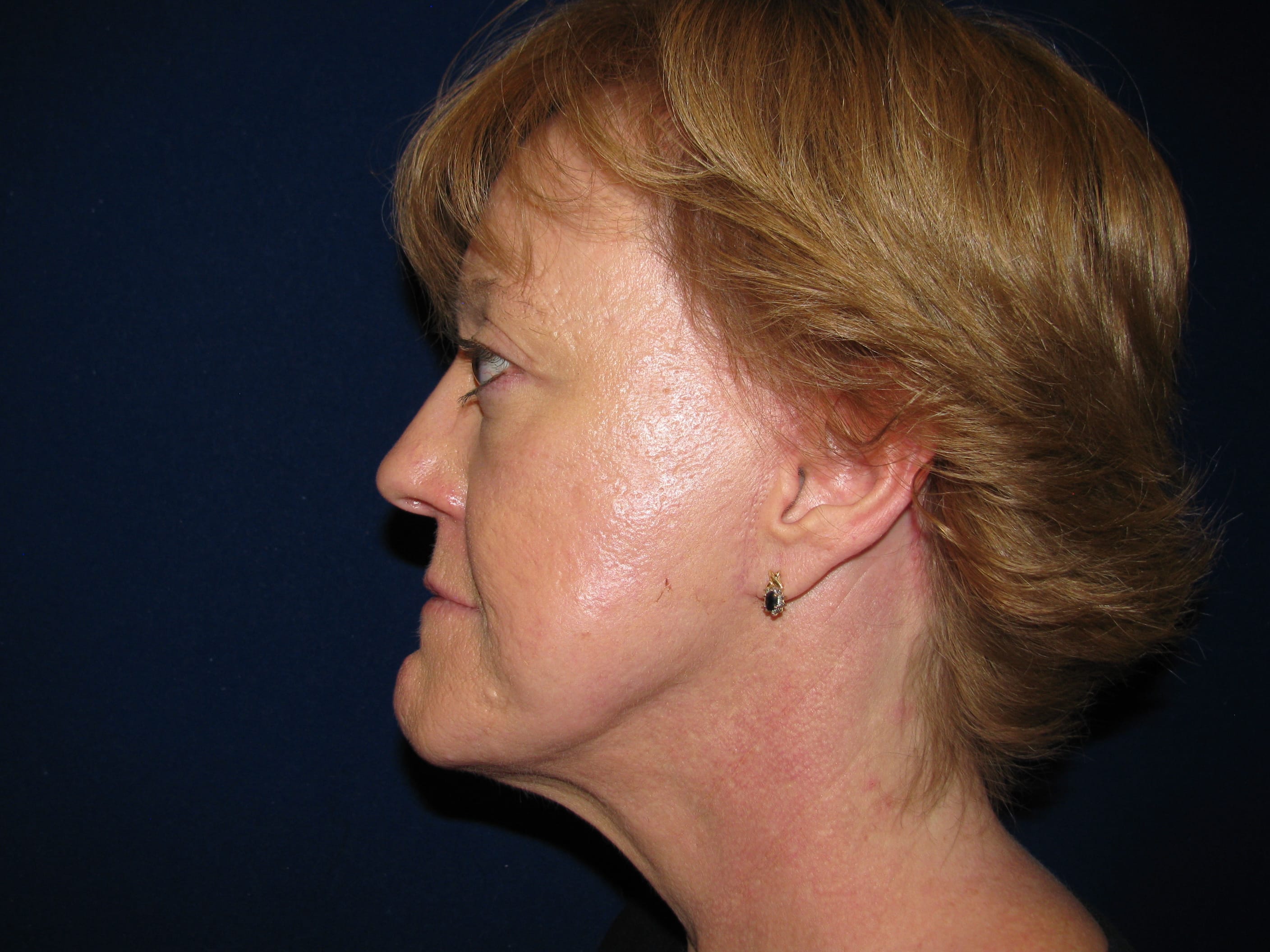 Facelift Before and After | LV Plastic Surgery